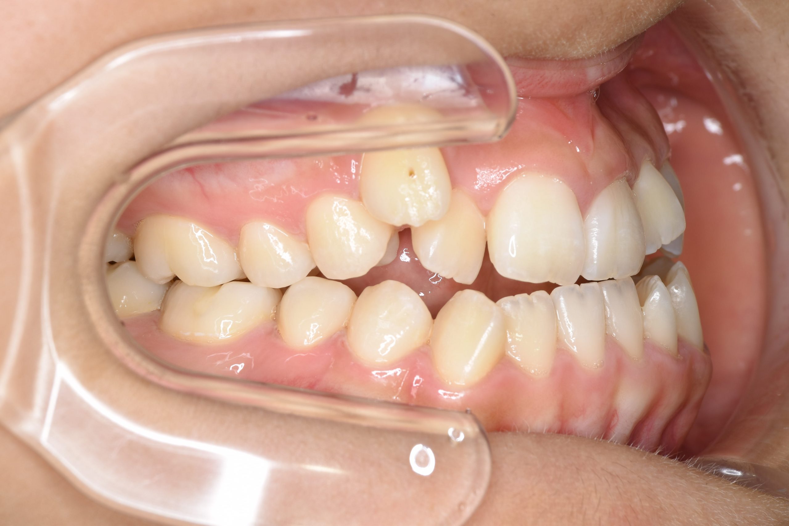 全顎ワイヤー矯正　症例_29