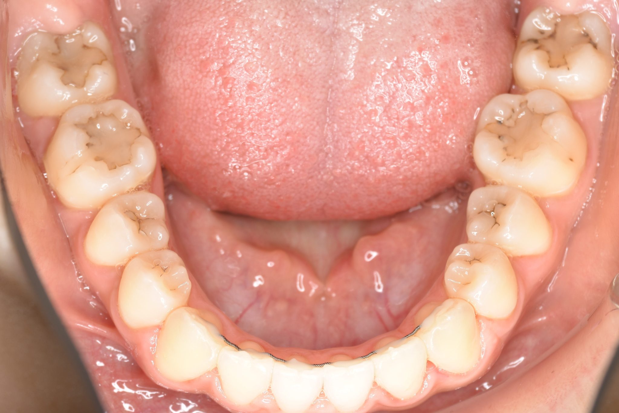 全顎ワイヤー矯正　症例_29