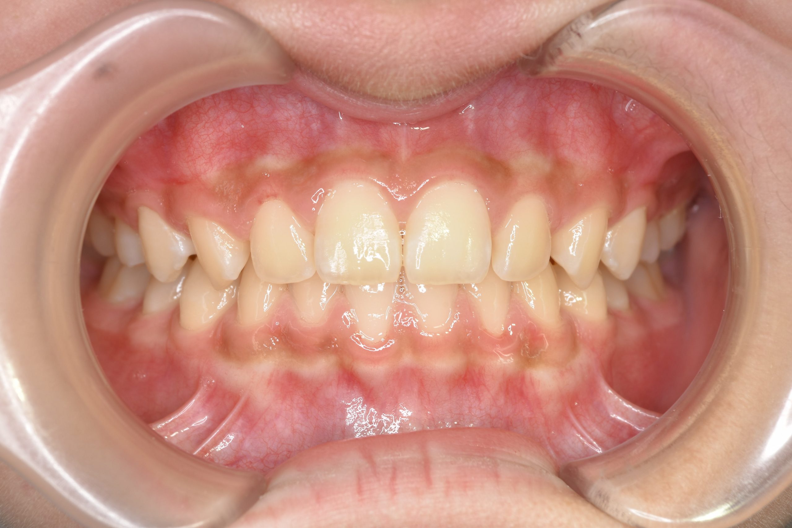 全顎ワイヤー矯正　症例_108