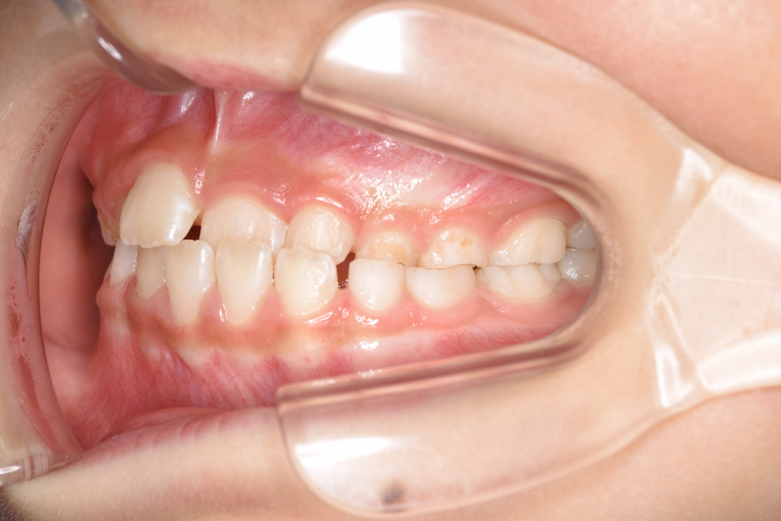 全顎ワイヤー矯正　症例_108