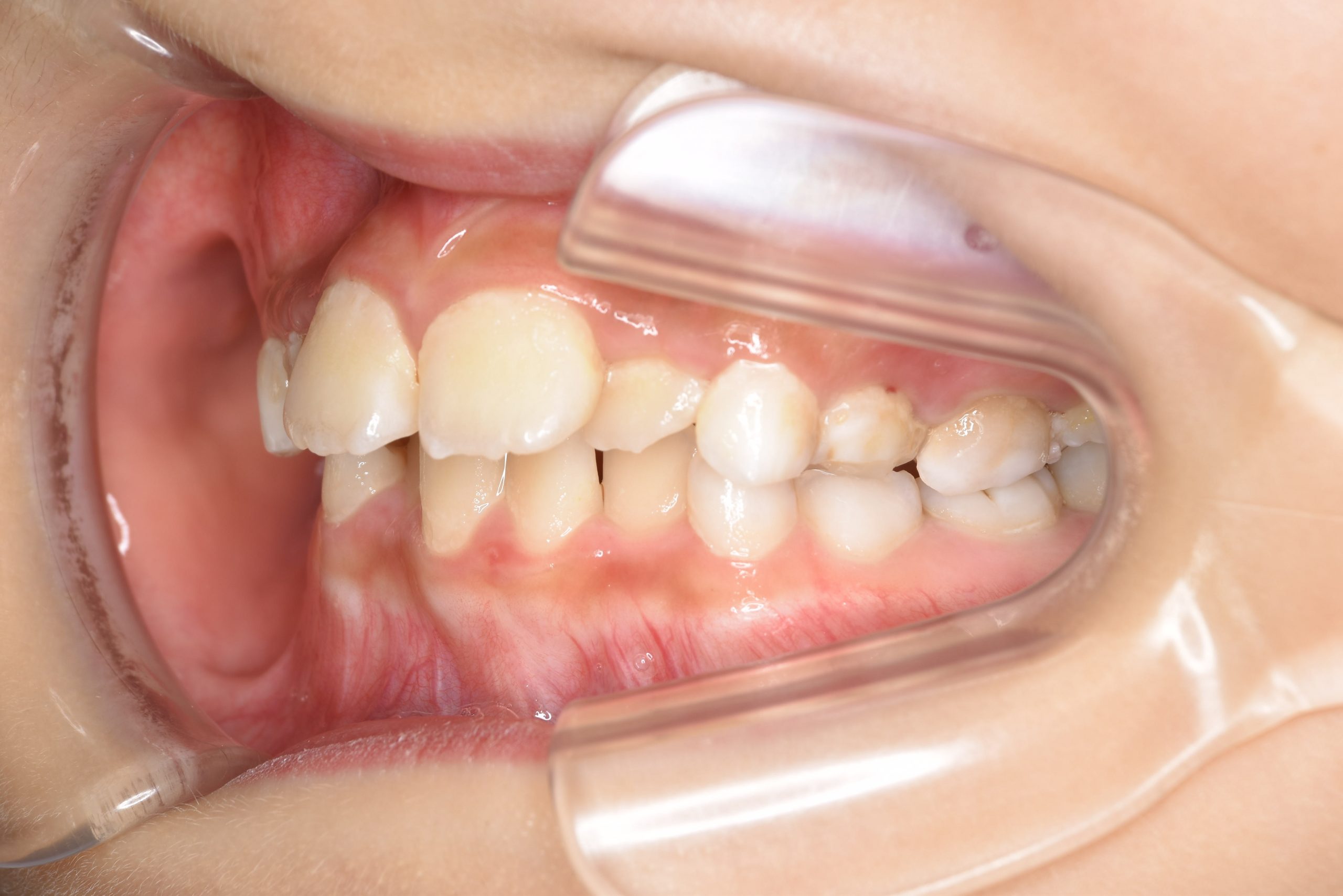 全顎ワイヤー矯正　症例_185