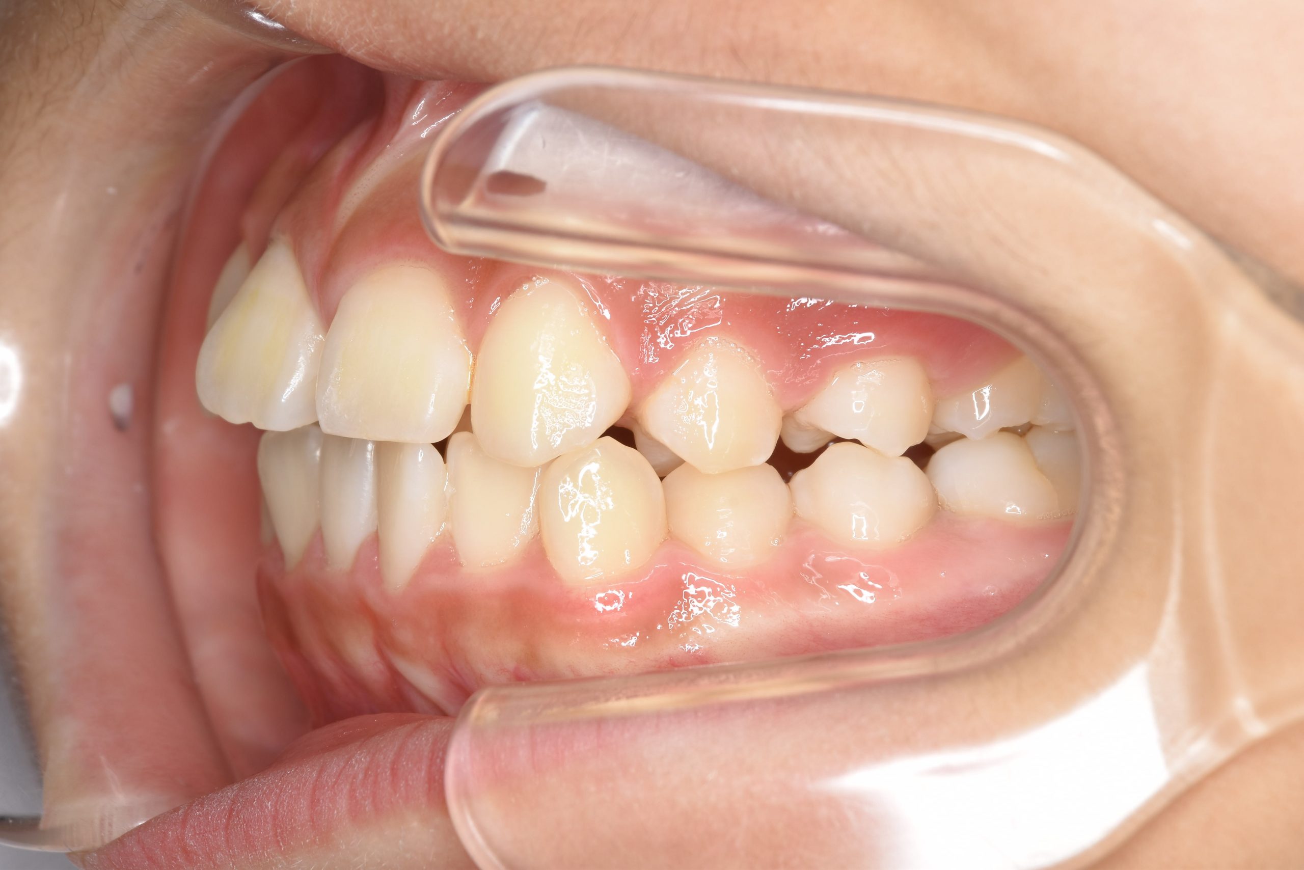 全顎ワイヤー矯正　症例_191