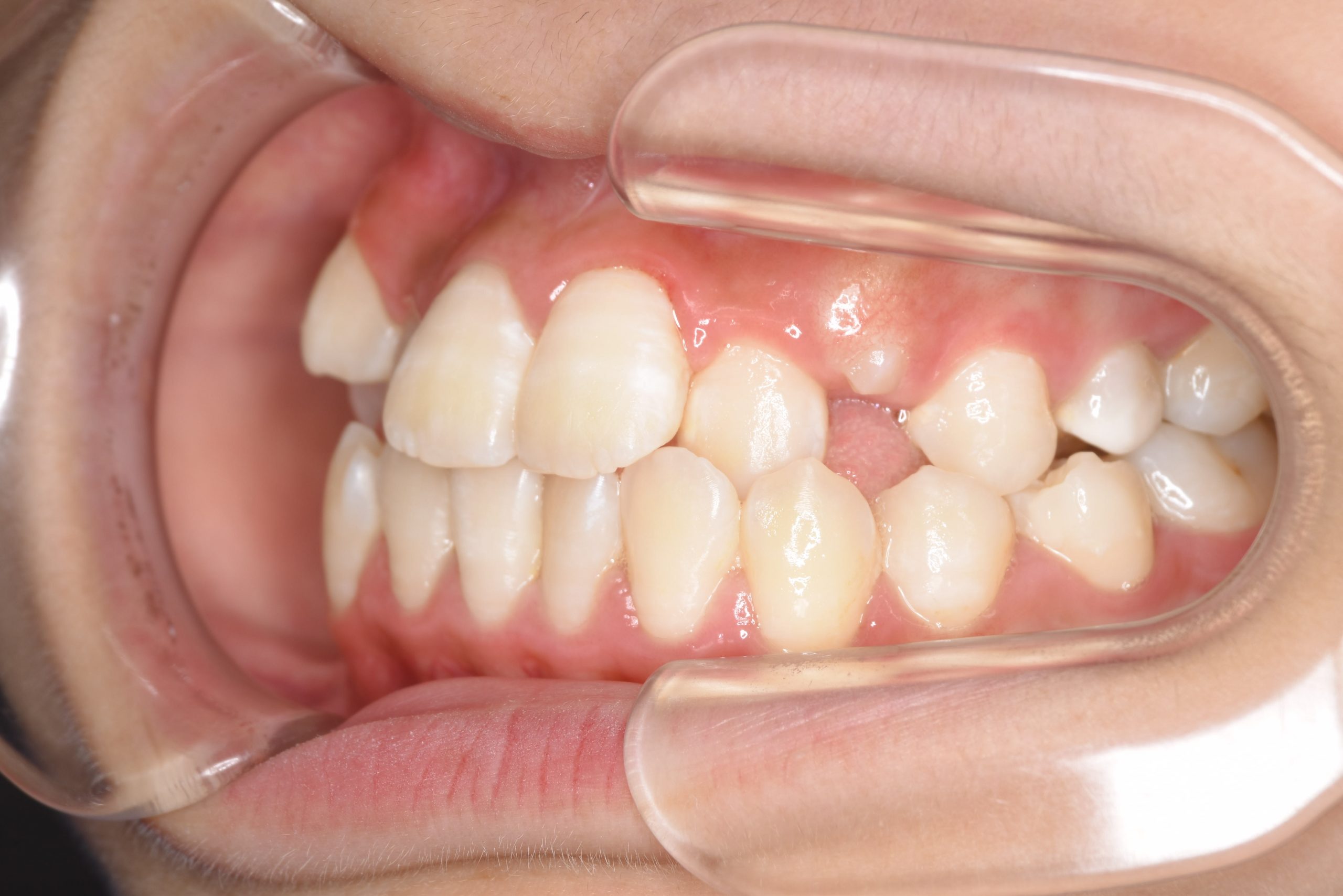 全顎ワイヤー矯正　症例_198