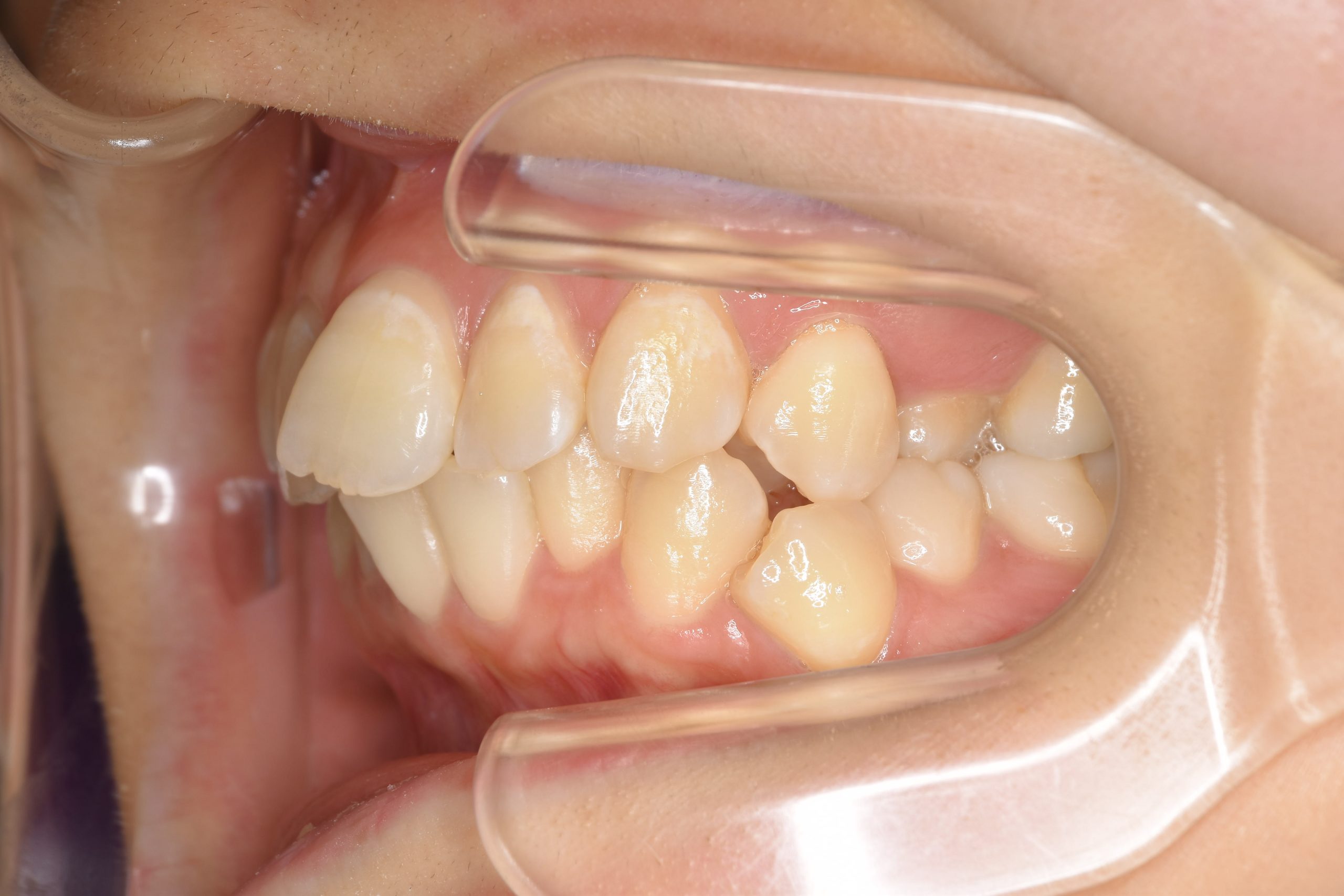 全顎ワイヤー矯正　症例_200