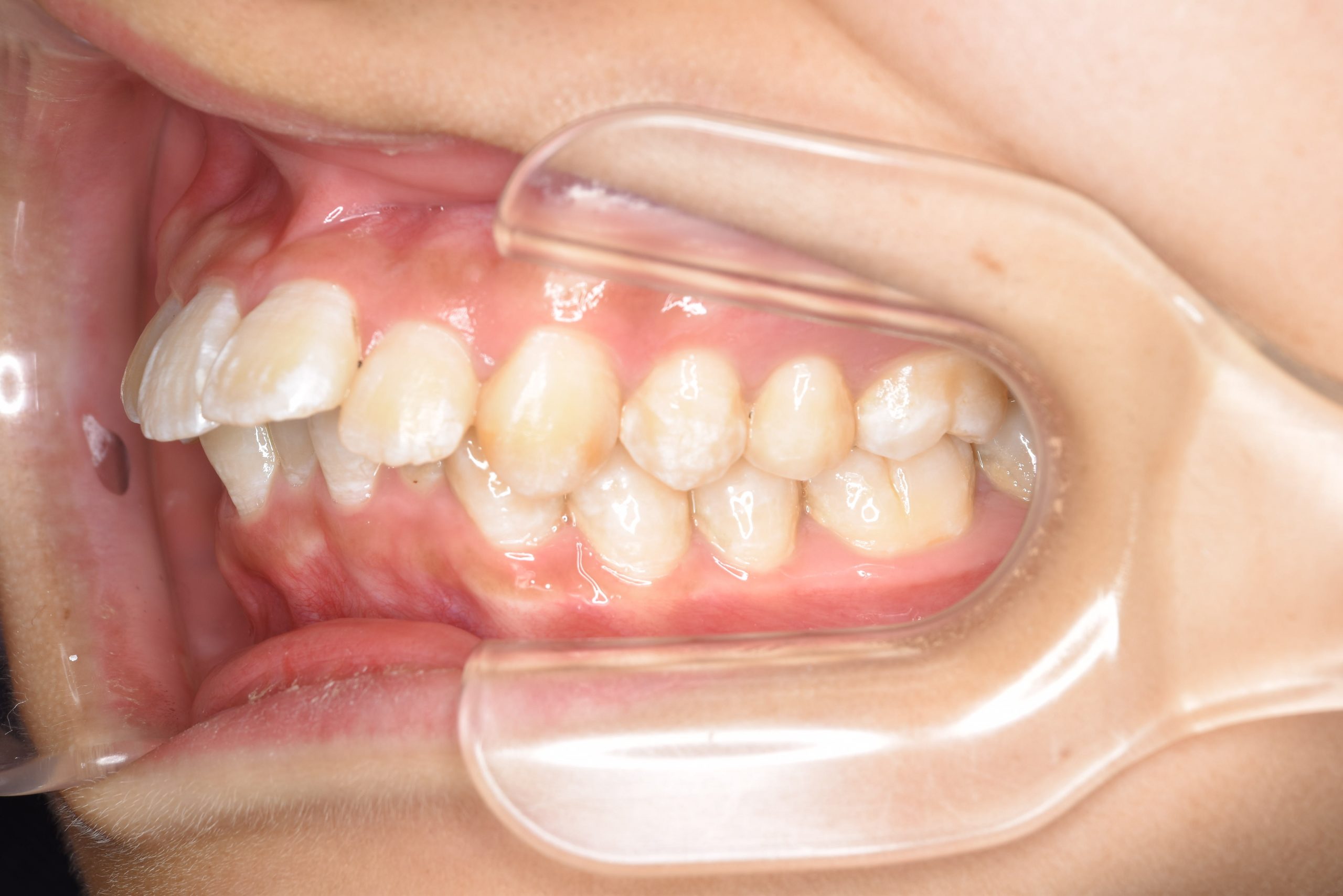 全顎ワイヤー矯正　症例_252