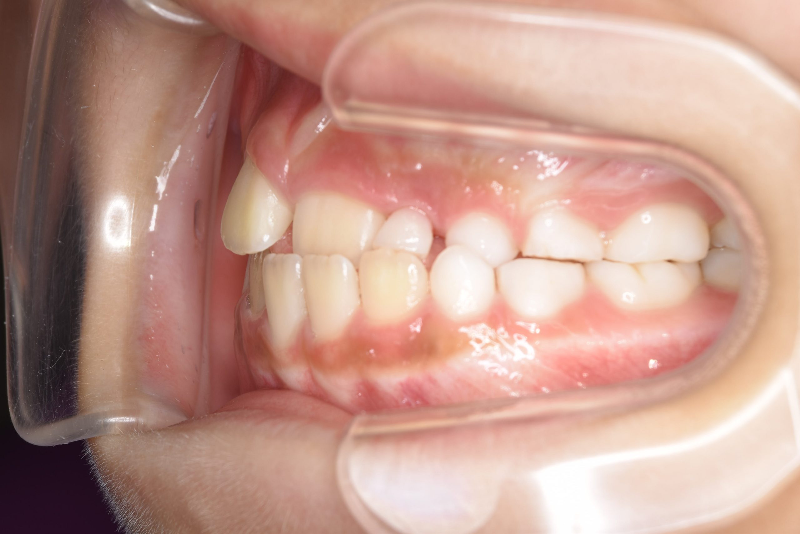 全顎ワイヤー矯正　症例_261