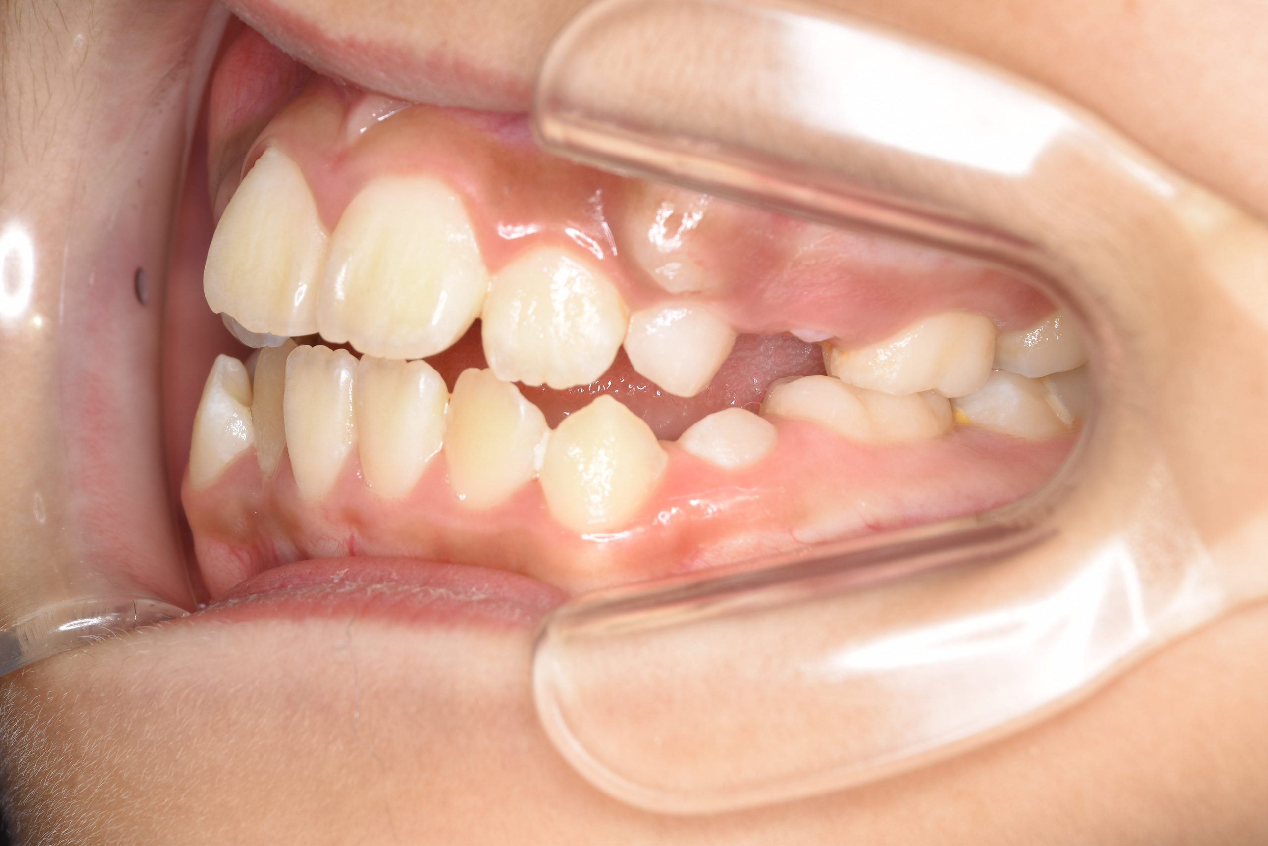 全顎ワイヤー矯正　症例_267