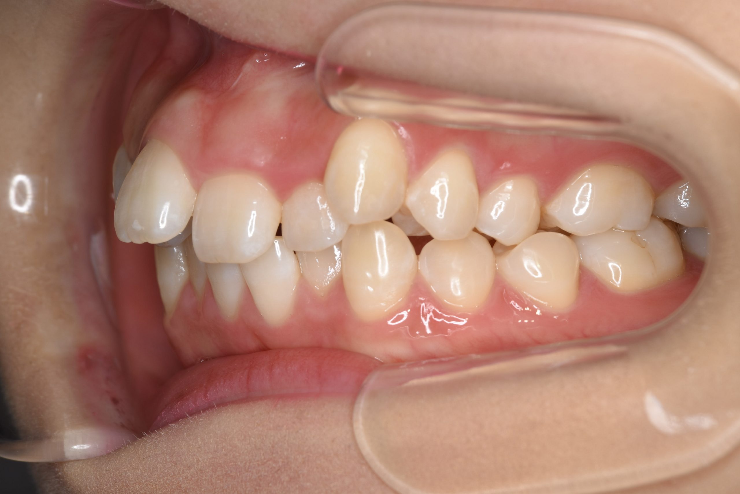 全顎ワイヤー矯正　症例_306