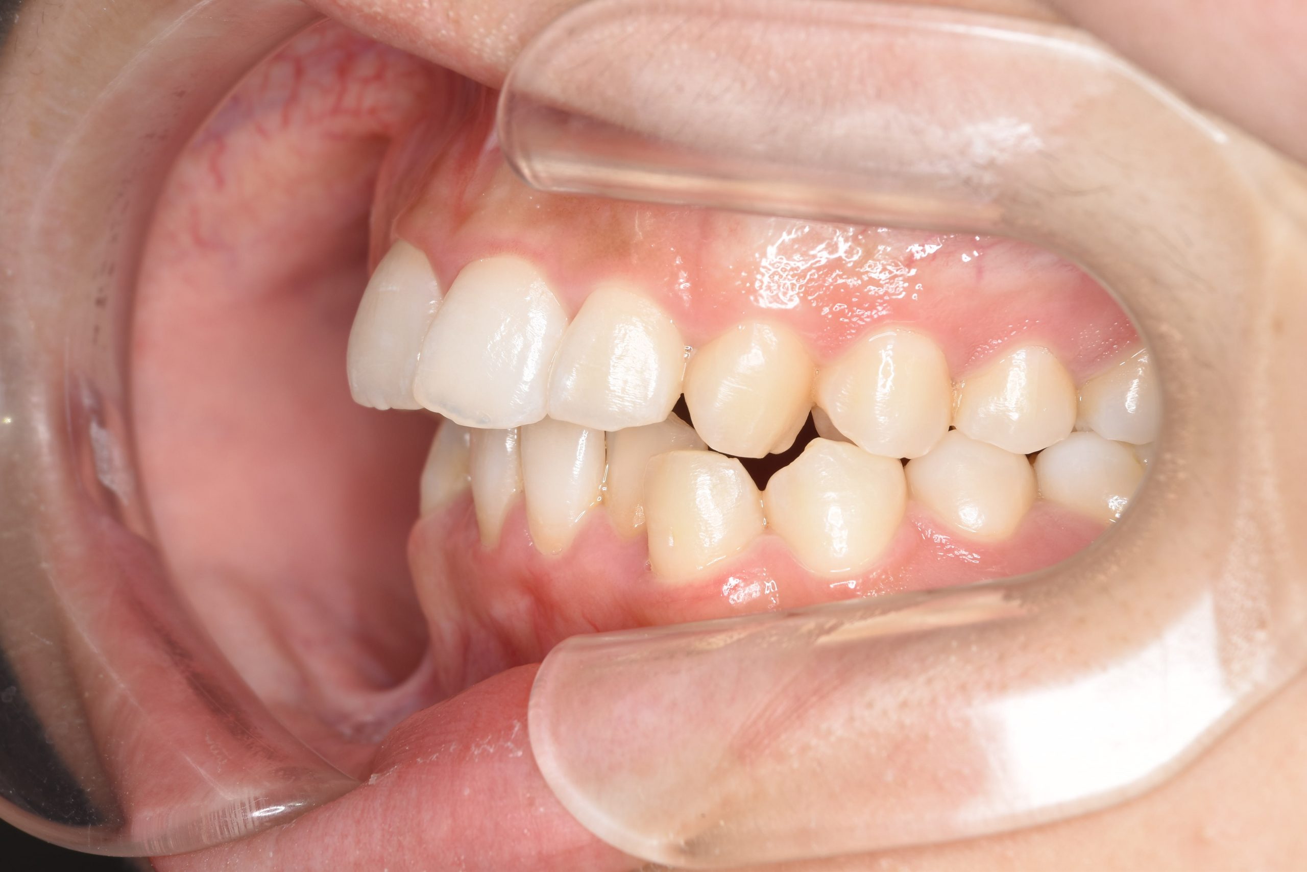 全顎ワイヤー矯正　症例_315