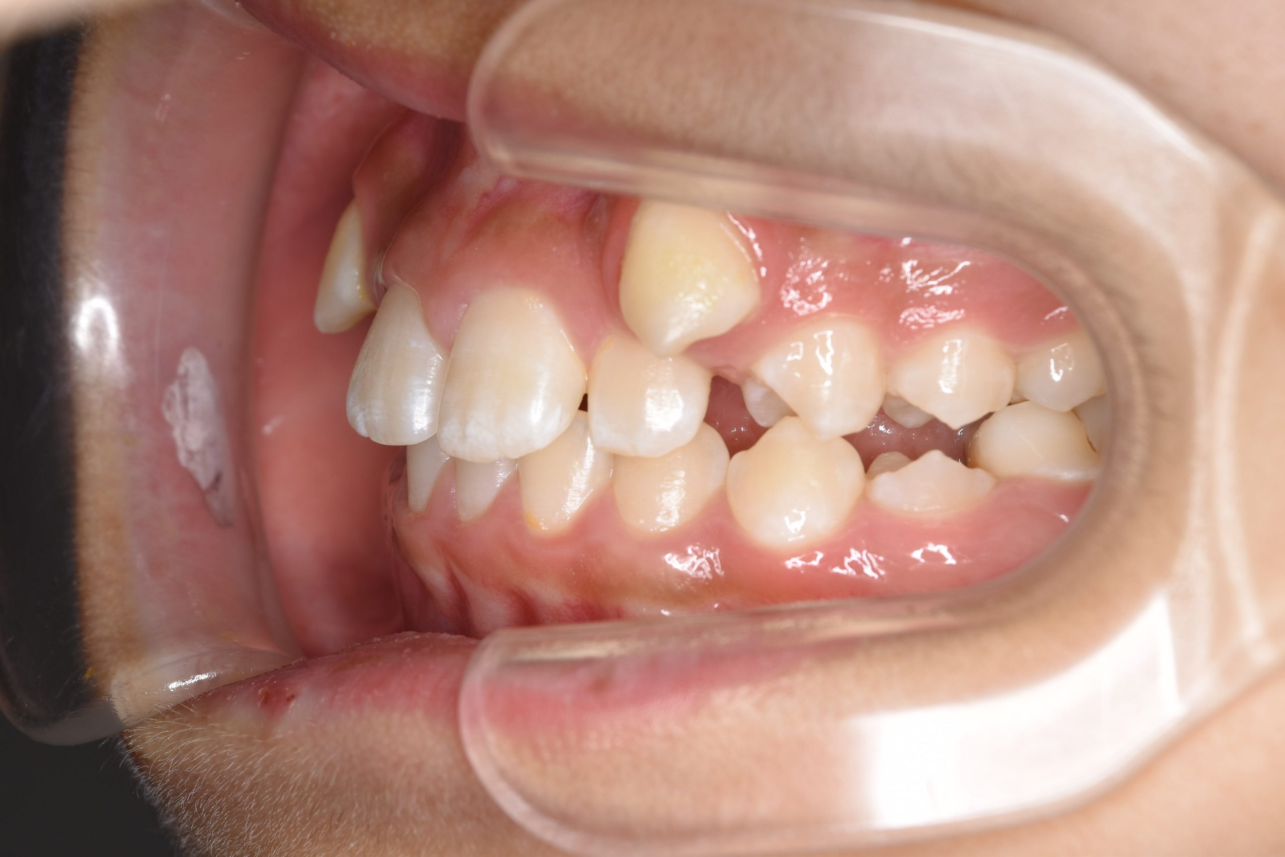 全顎ワイヤー矯正　症例_320