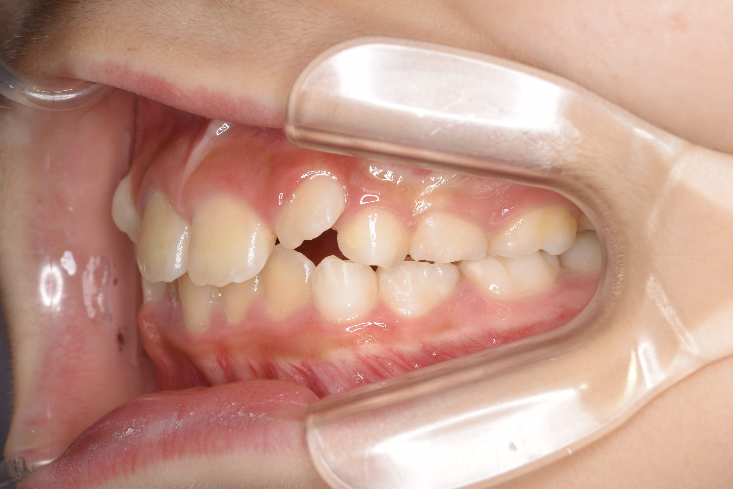 全顎ワイヤー矯正　症例_347