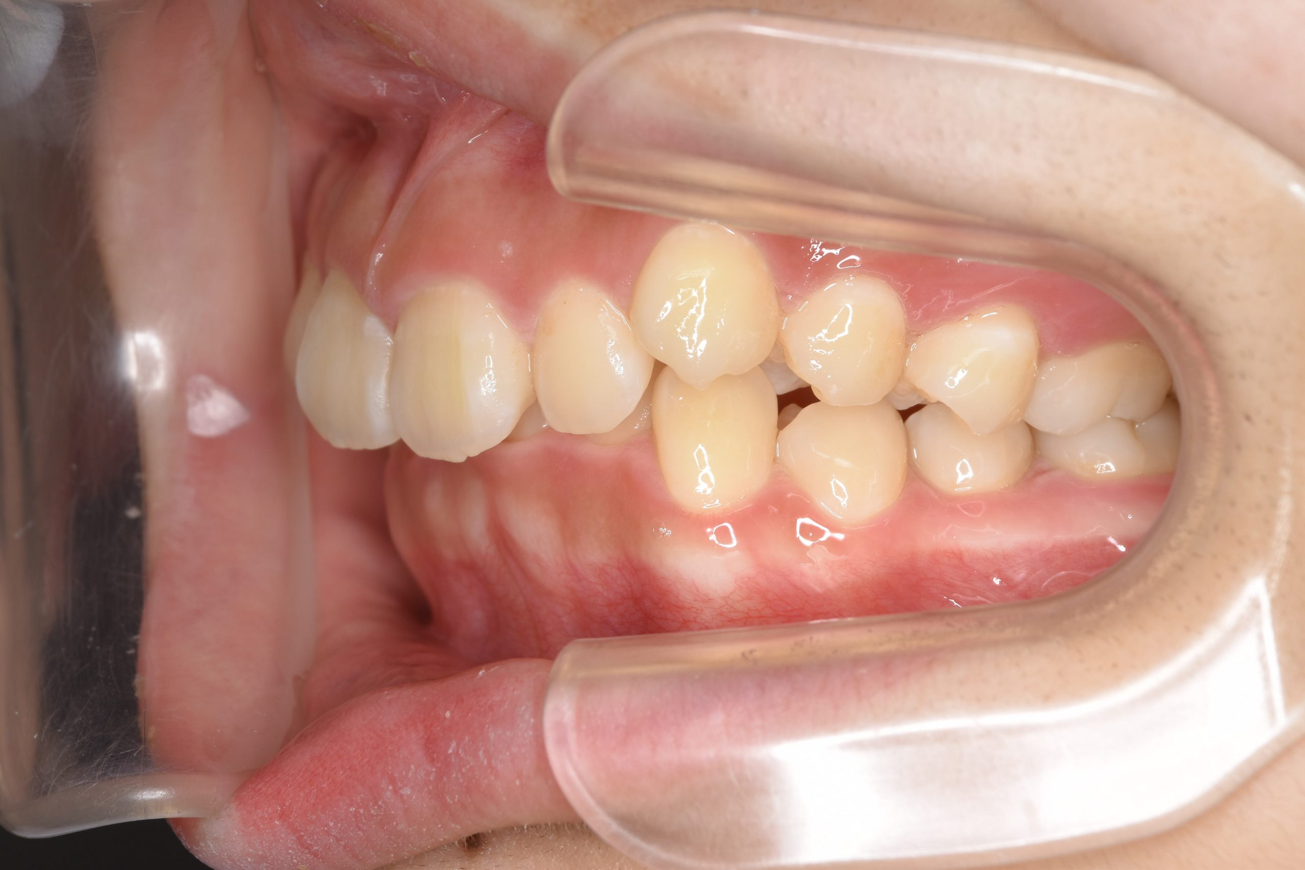 全顎ワイヤー矯正　症例_349