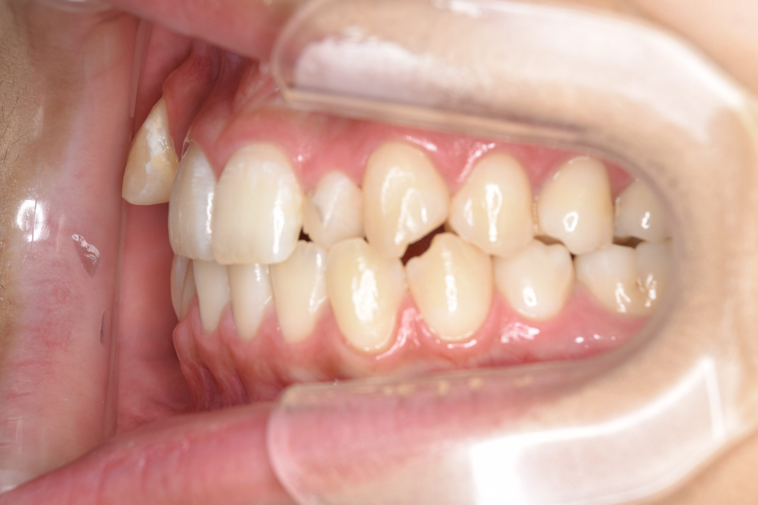 全顎ワイヤー矯正　症例_401