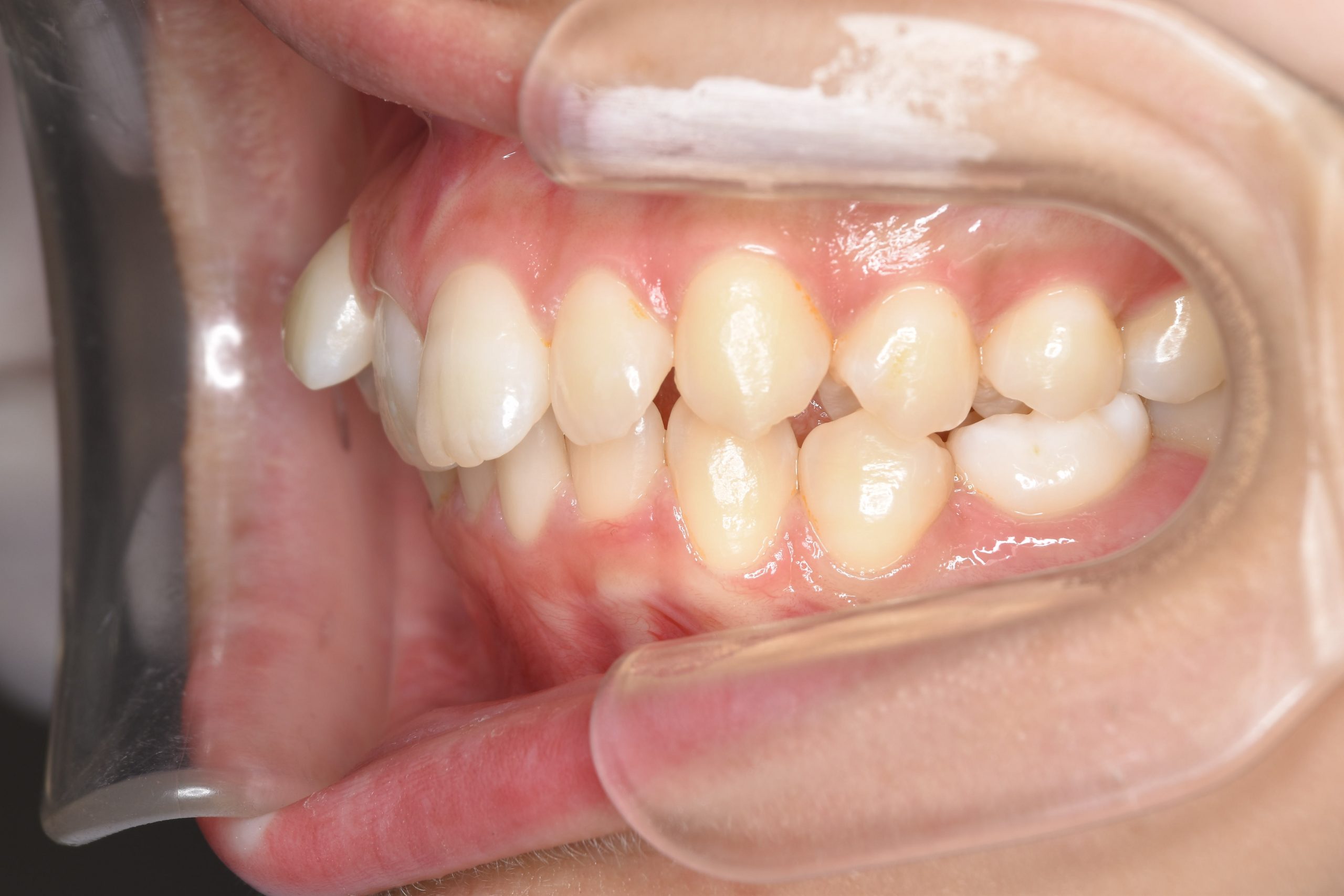 全顎ワイヤー矯正　症例_418