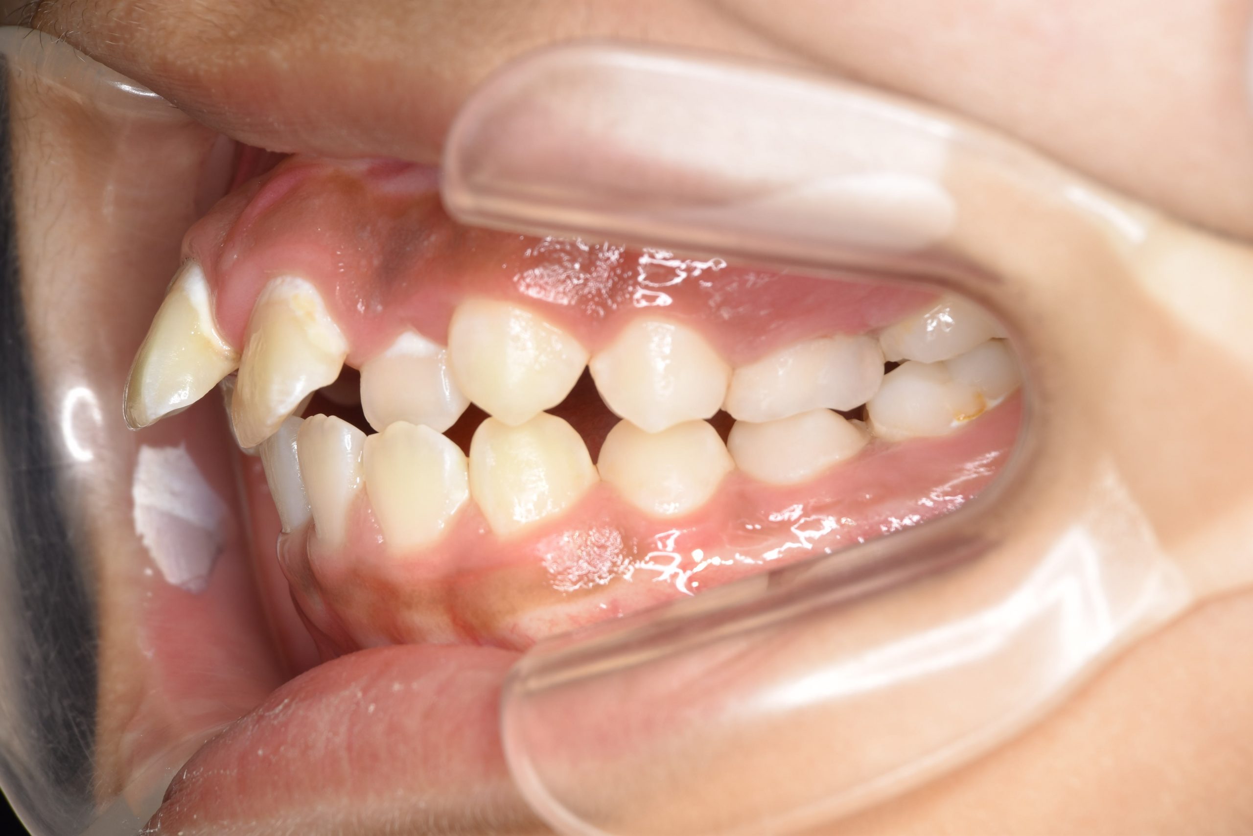 全顎ワイヤー矯正　症例_474