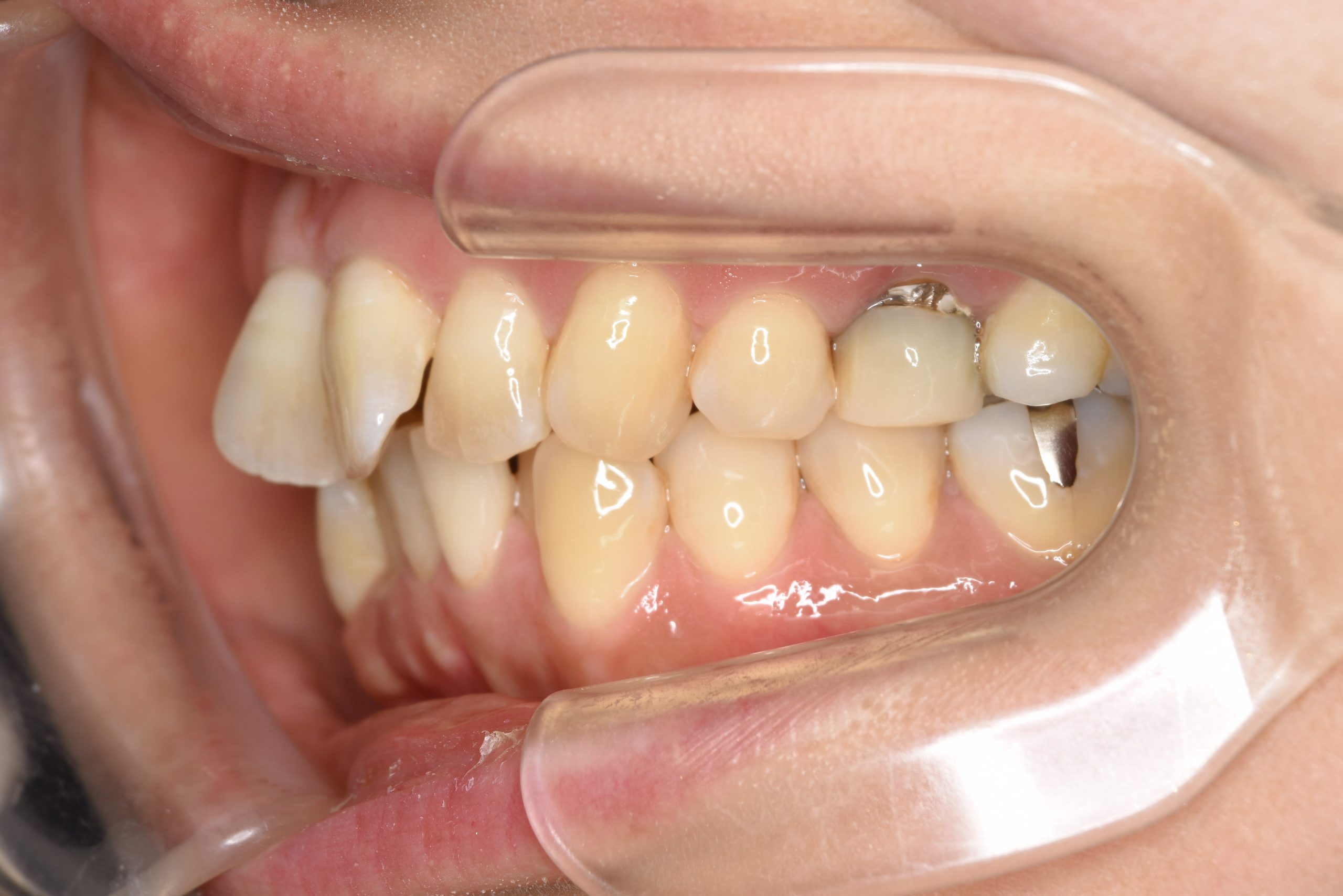 全顎ワイヤー矯正　症例_479