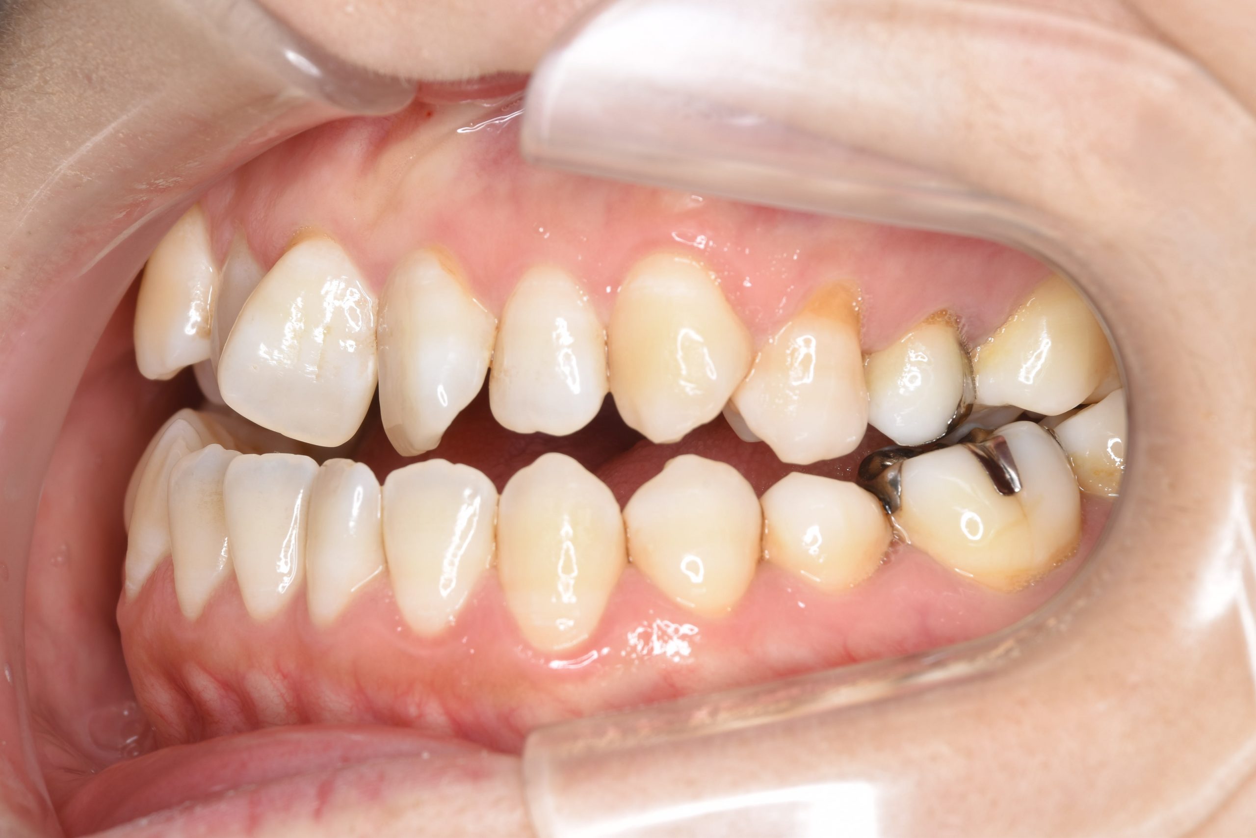 全顎ワイヤー矯正　症例_138