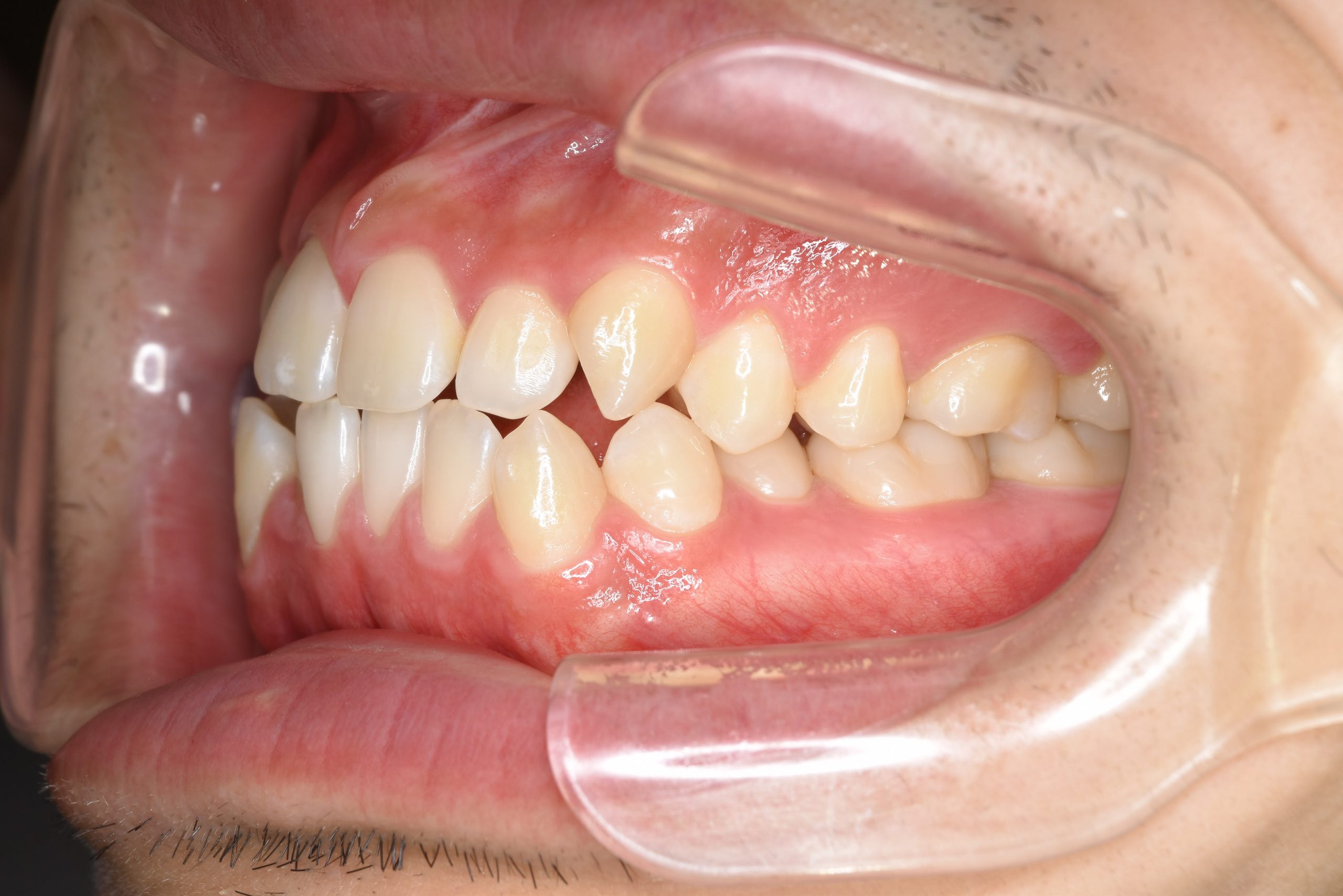 全顎ワイヤー矯正　症例_495