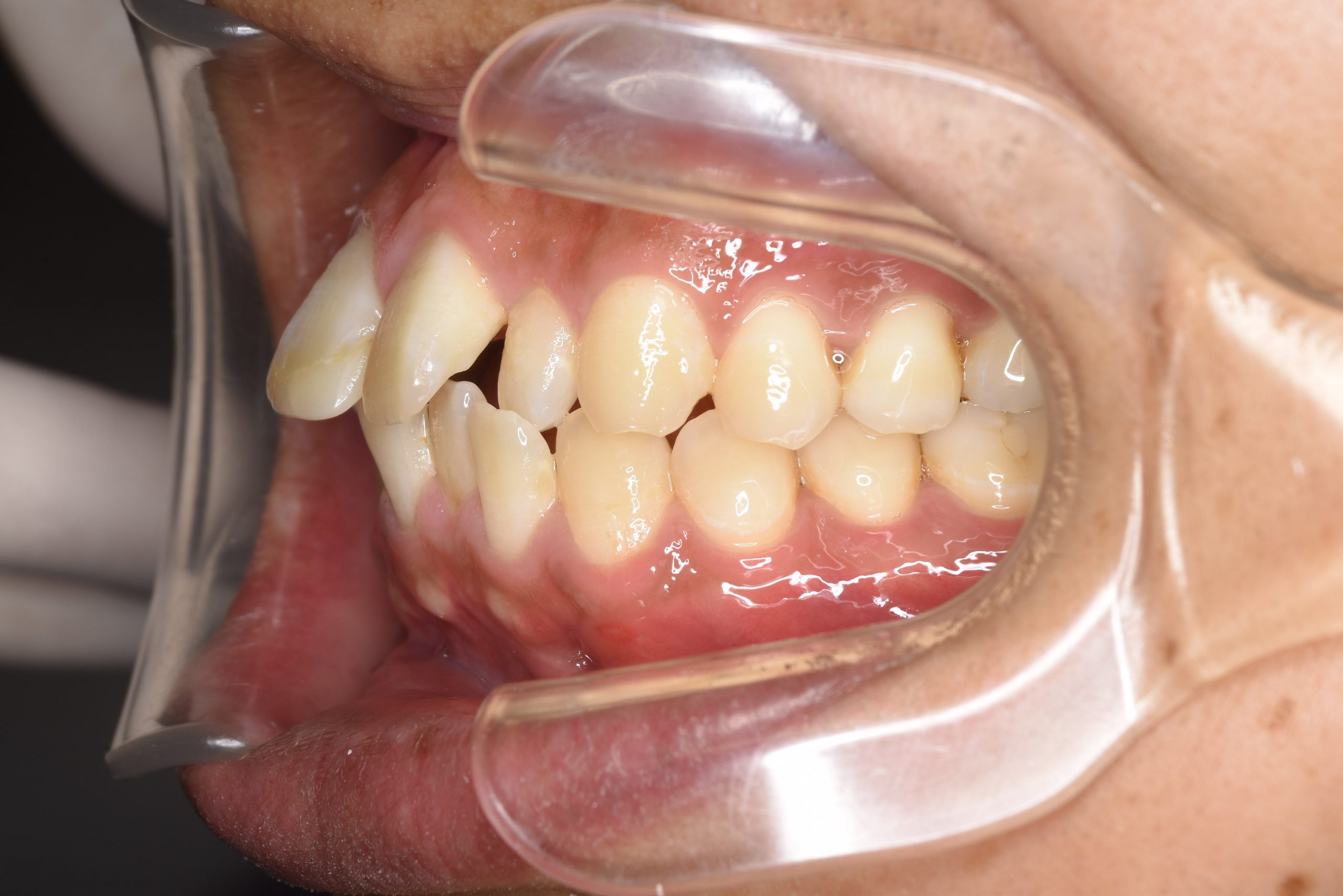 全顎ワイヤー矯正　症例_510