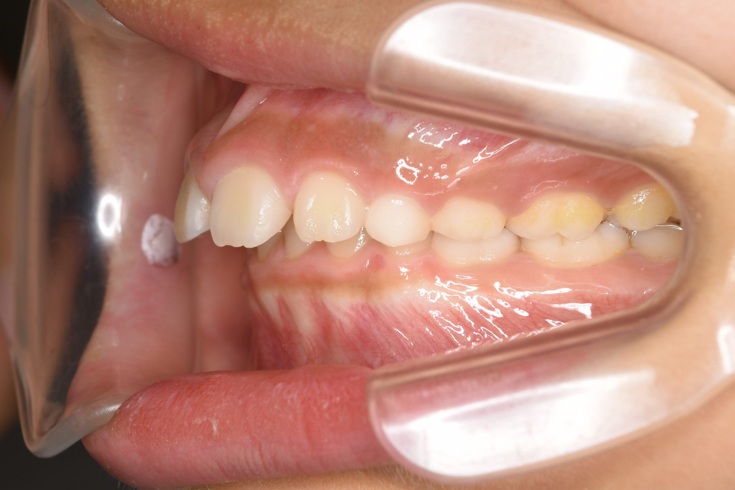 全顎ワイヤー矯正　症例_547