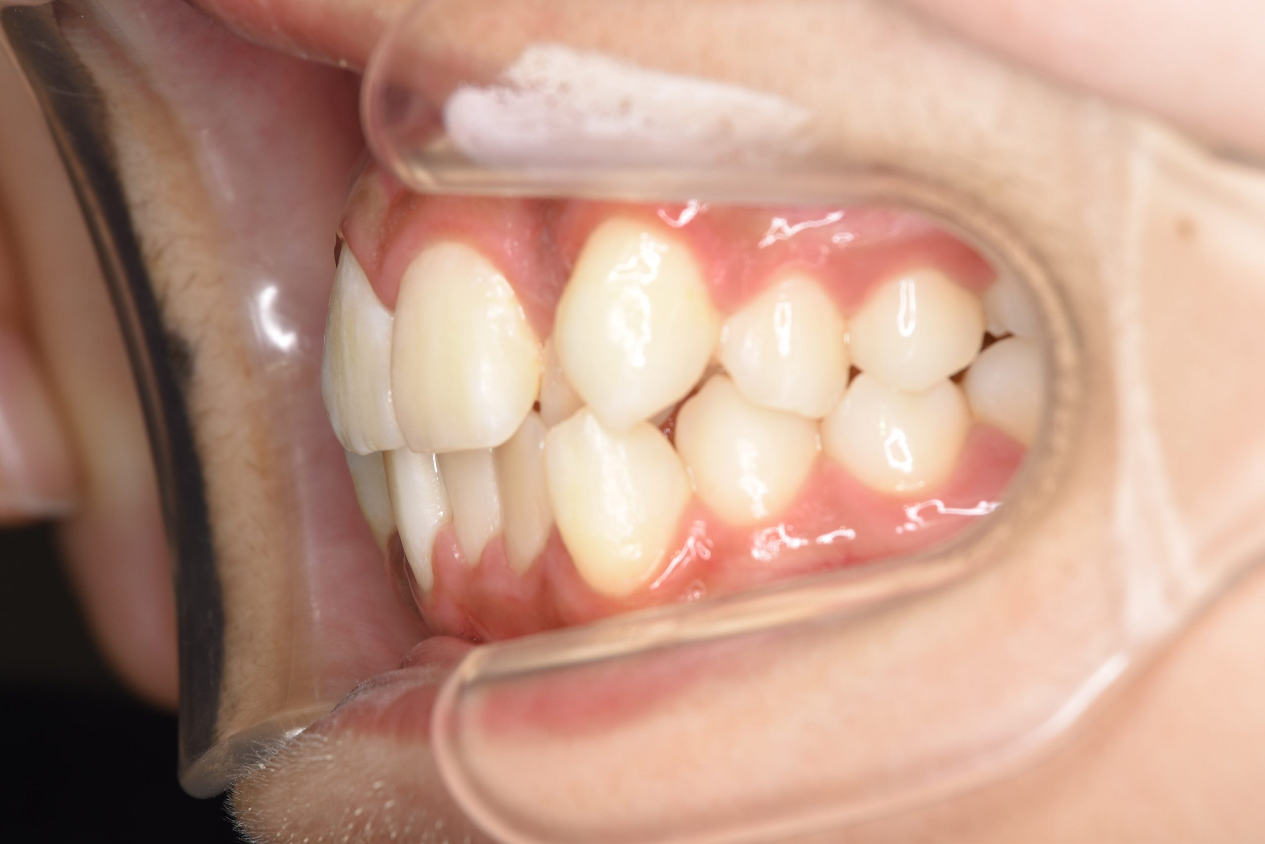 全顎ワイヤー矯正　症例_551