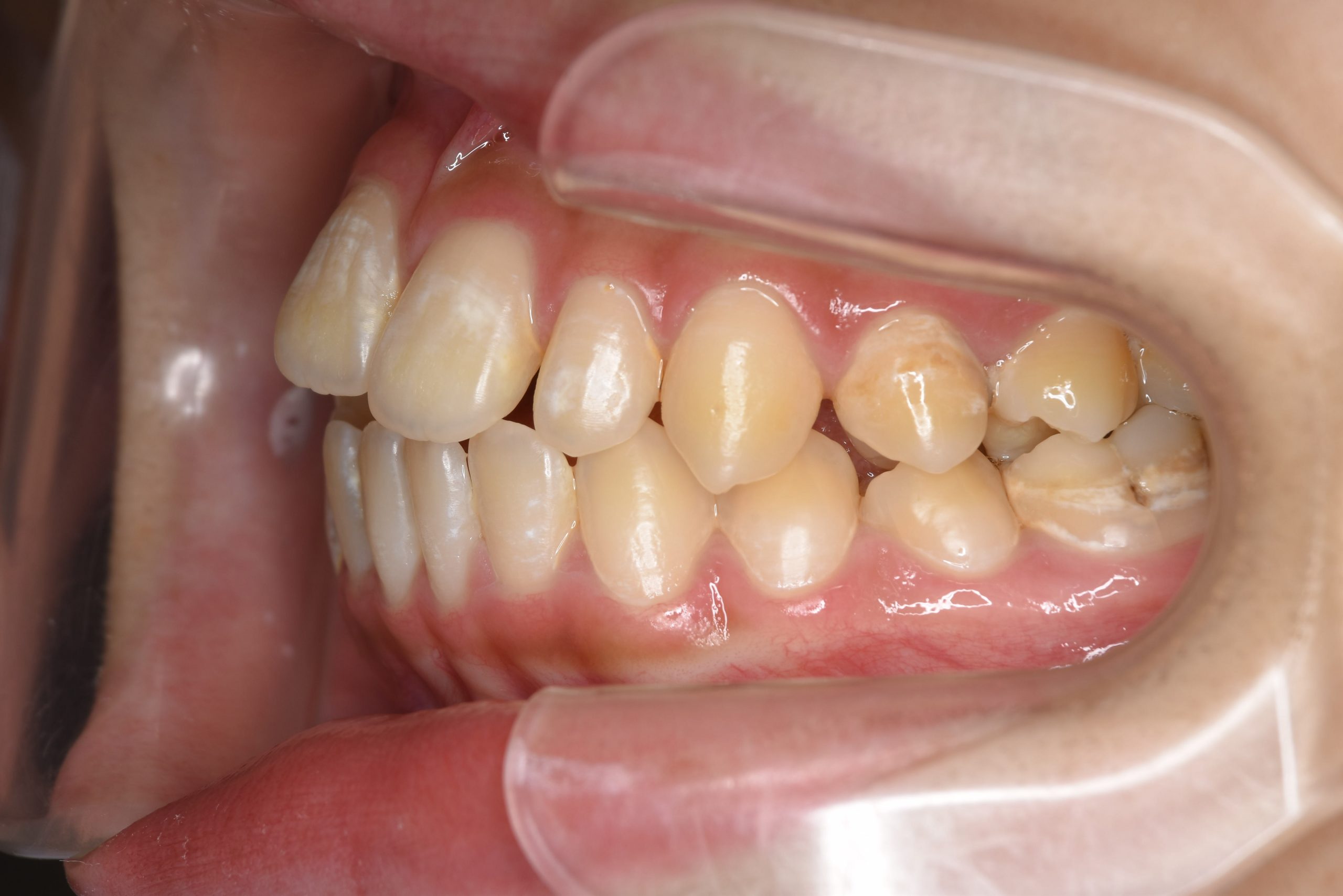 全顎ワイヤー矯正　症例_640