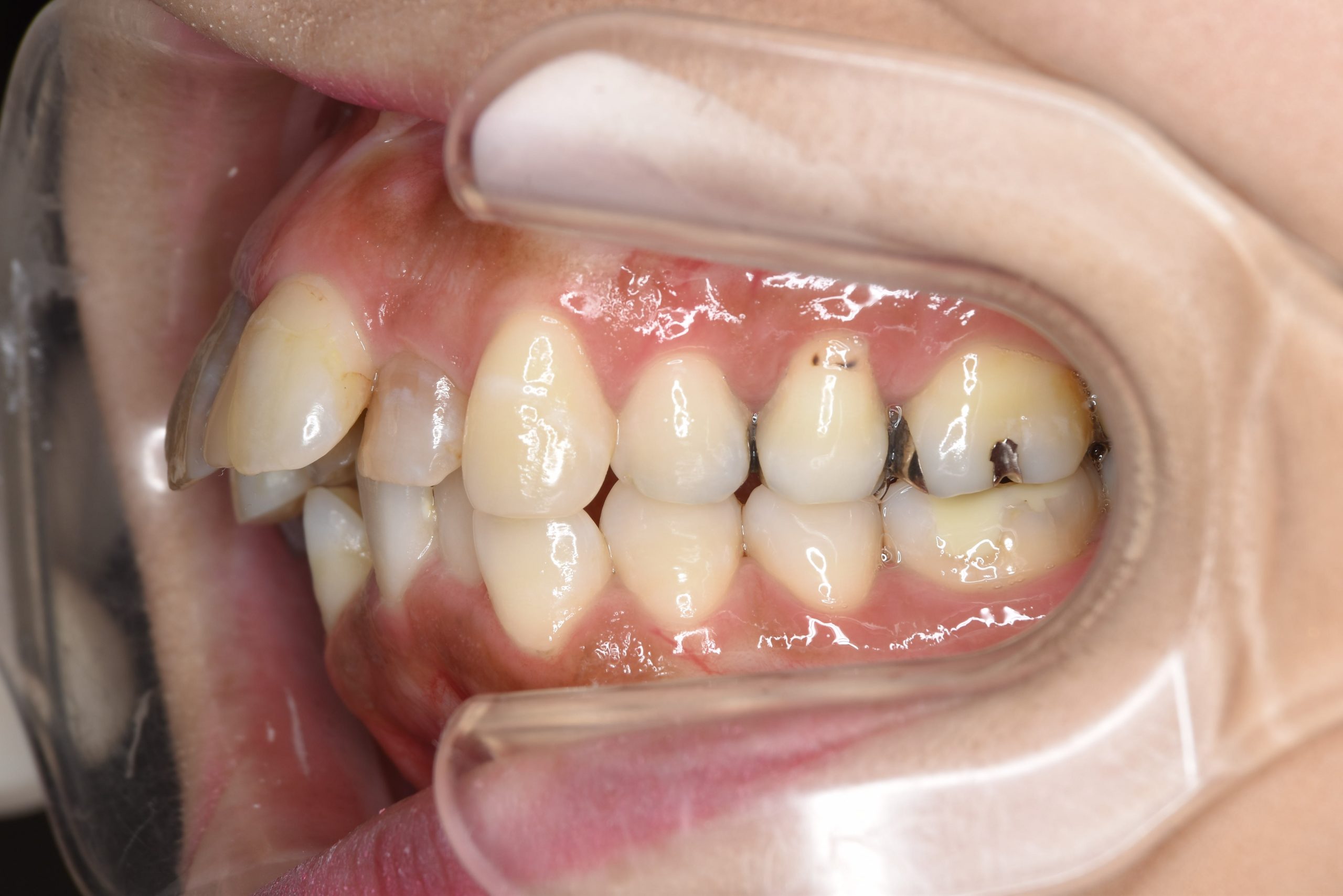 全顎ワイヤー矯正　症例_649