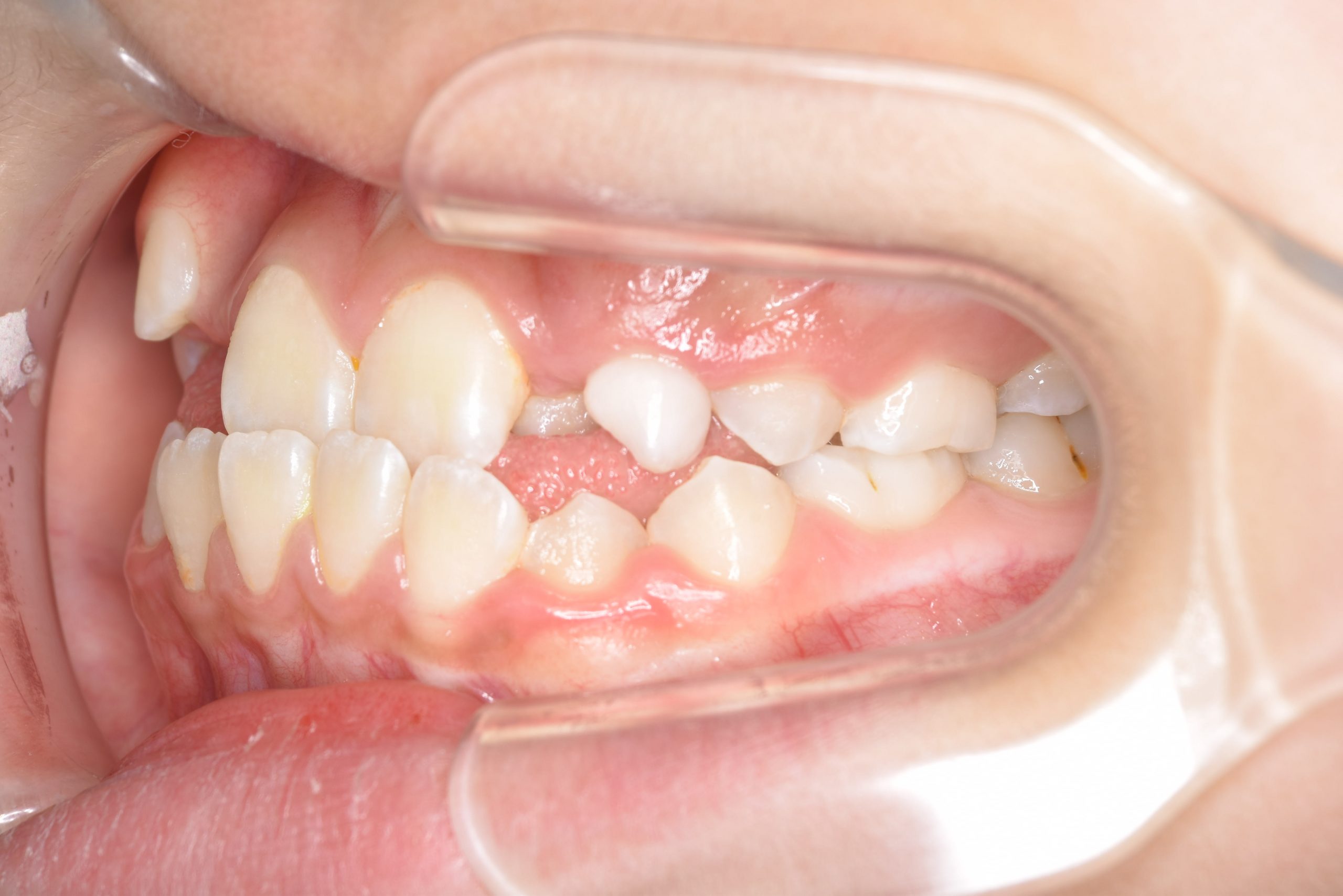 全顎ワイヤー矯正　症例_139