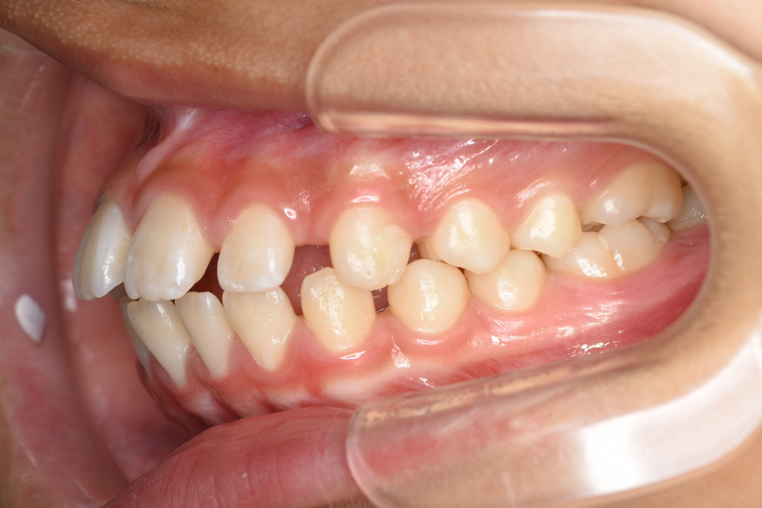 全顎ワイヤー矯正　症例_681