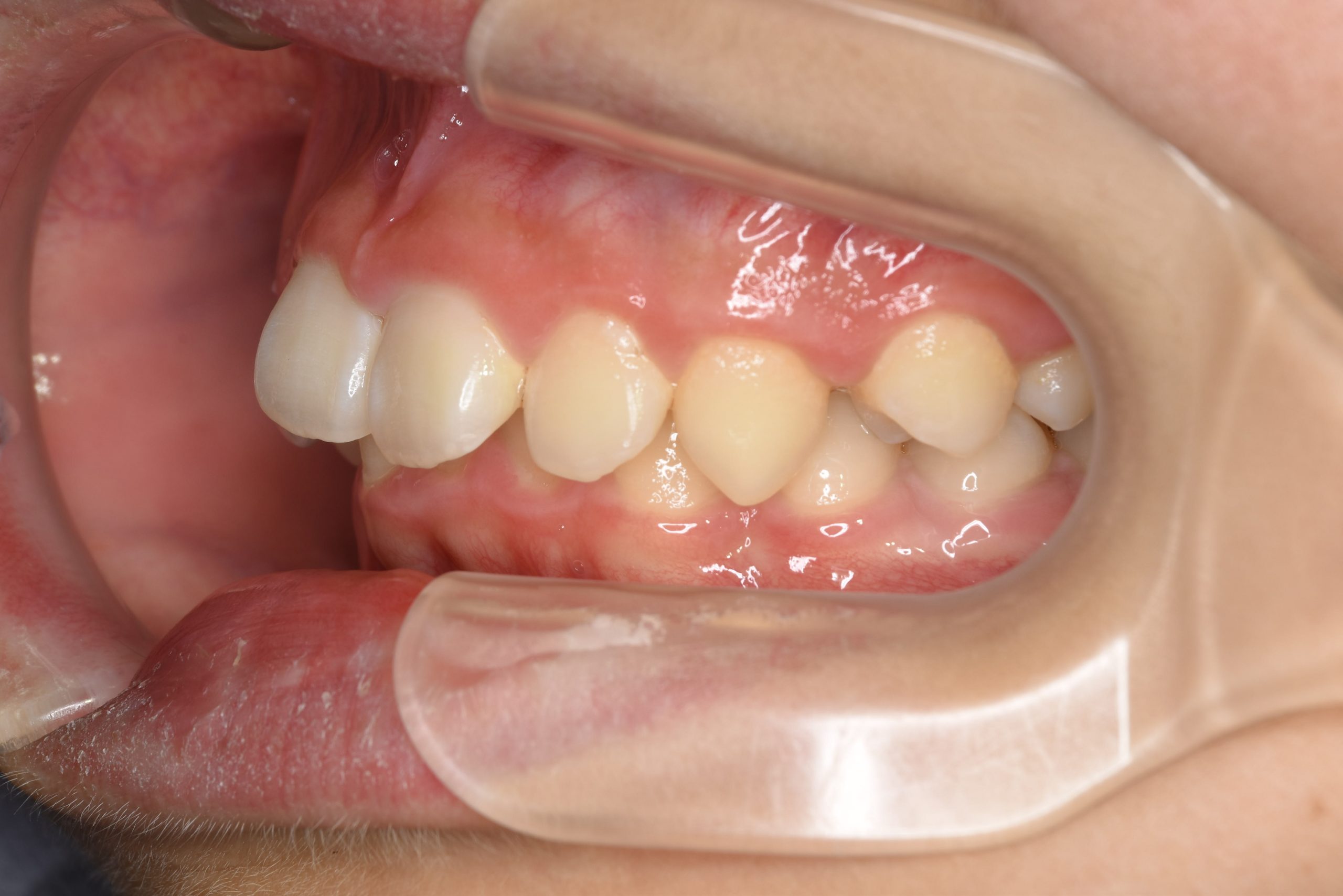 全顎ワイヤー矯正　症例_758