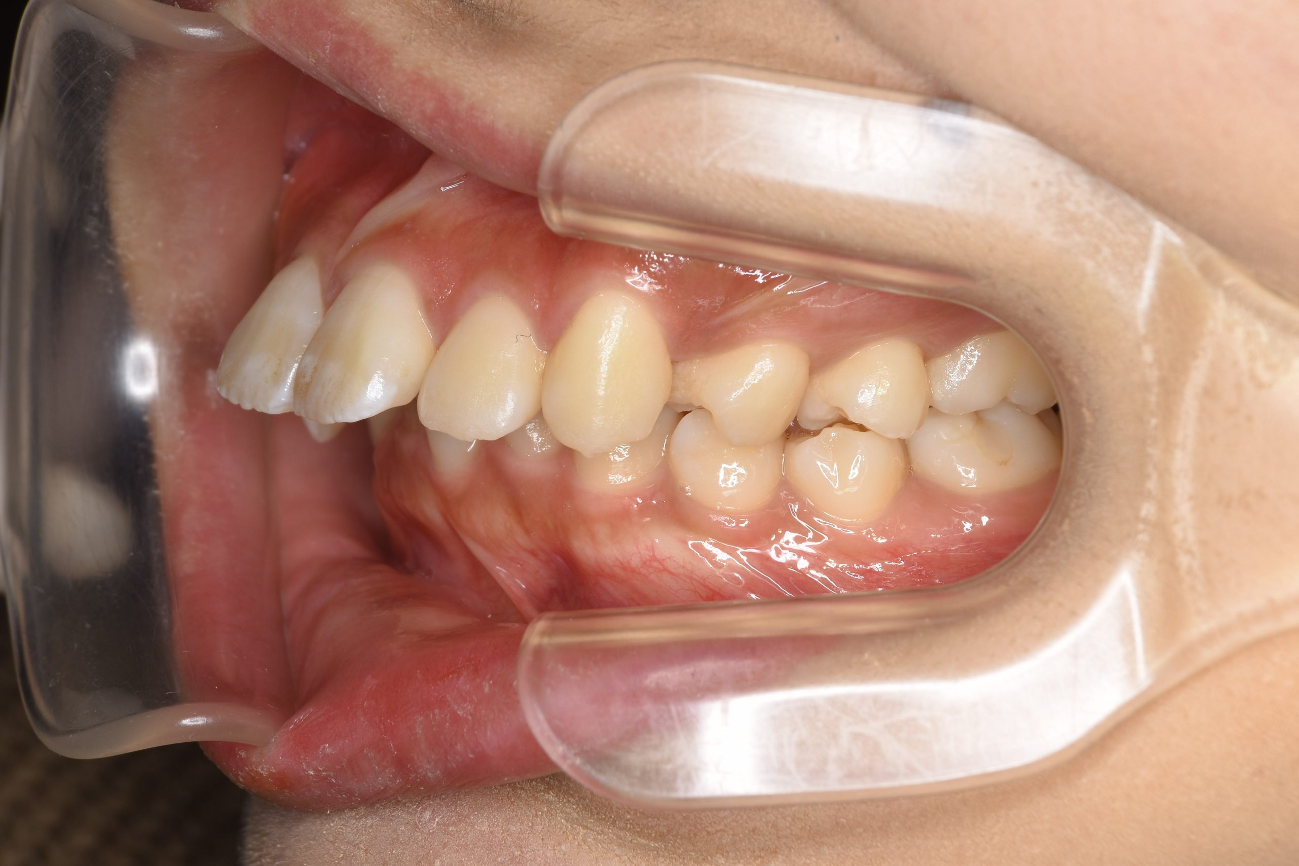 全顎ワイヤー矯正　症例_793