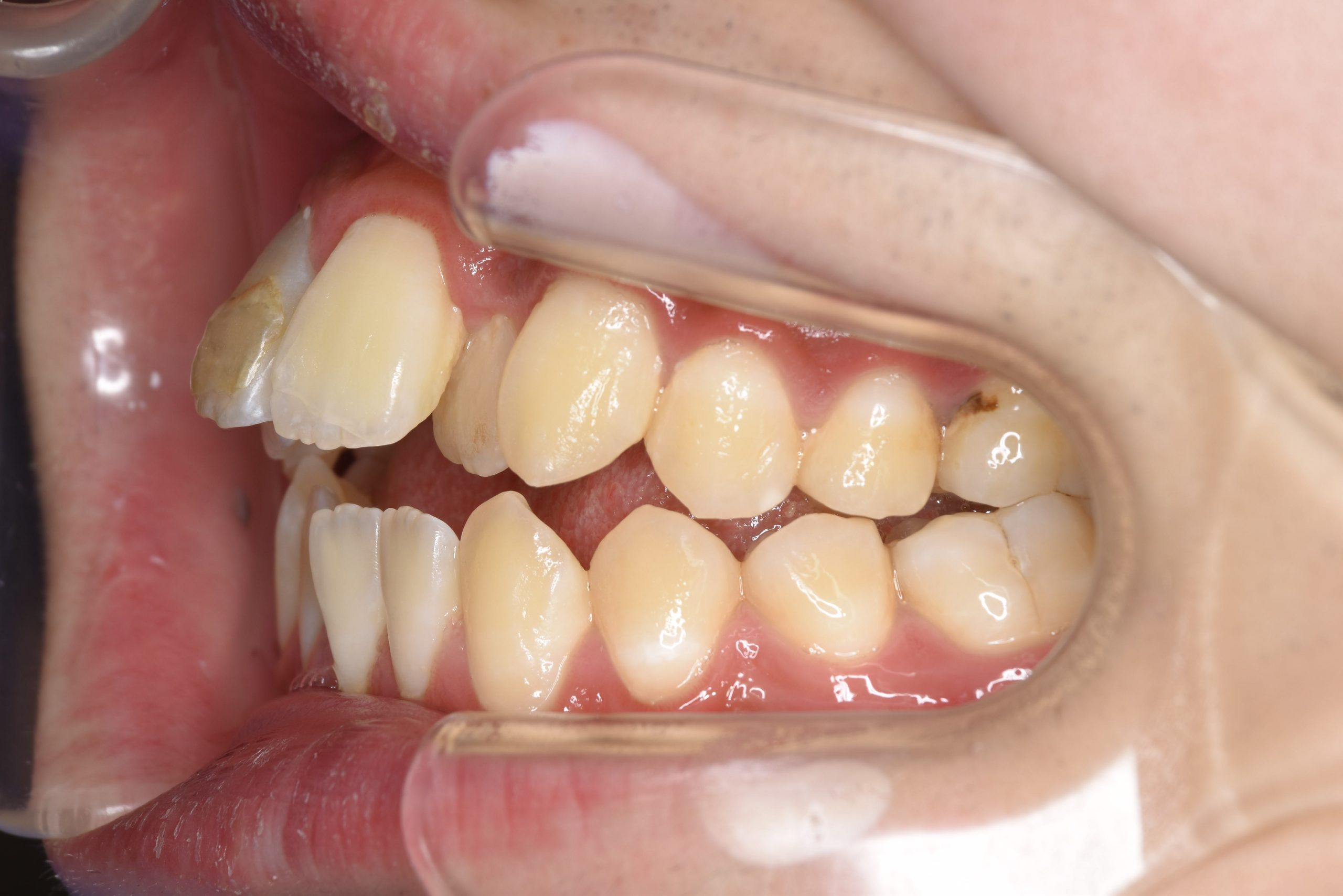 全顎ワイヤー矯正　症例_798