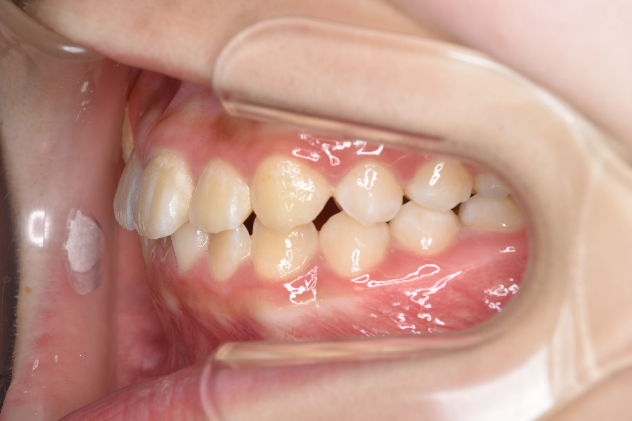 全顎ワイヤー矯正　症例_805