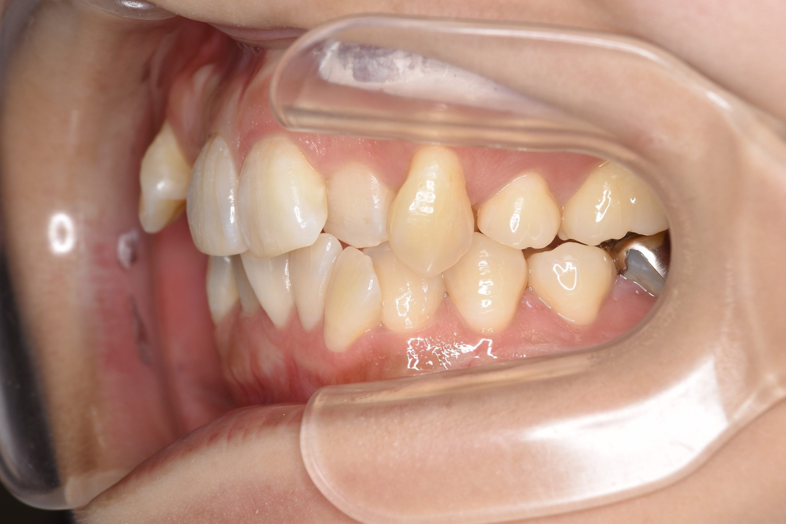 全顎ワイヤー矯正　症例_814