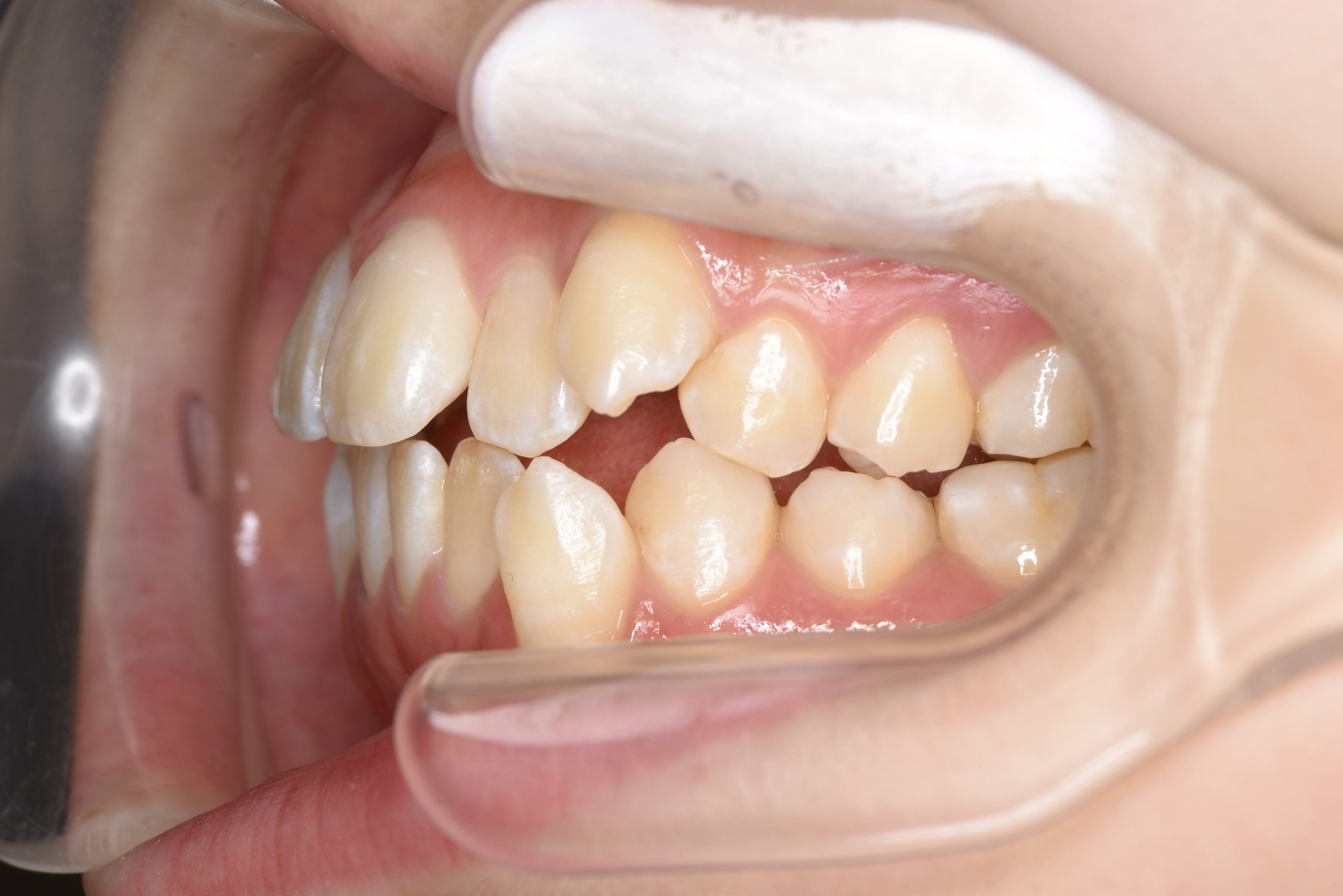 全顎ワイヤー矯正　症例_815