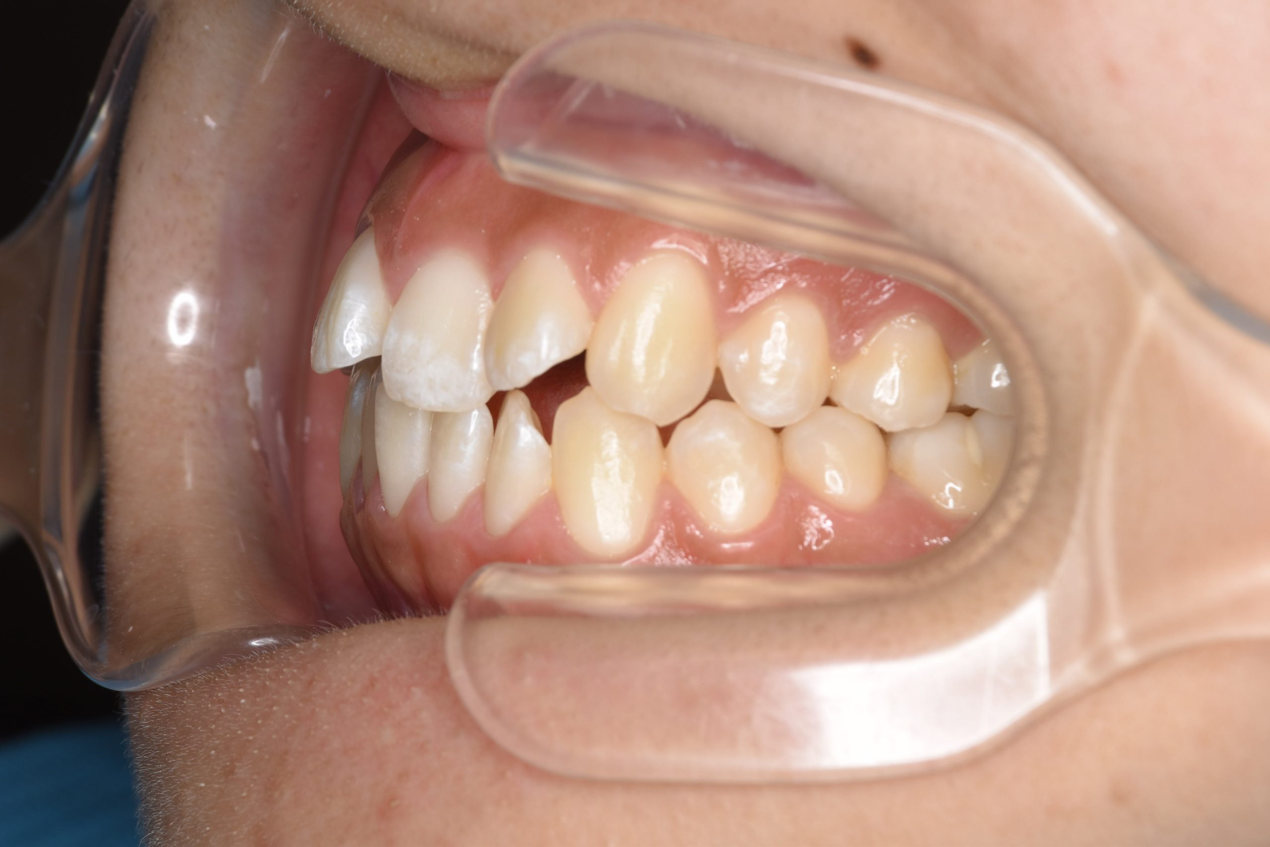 全顎ワイヤー矯正　症例_839