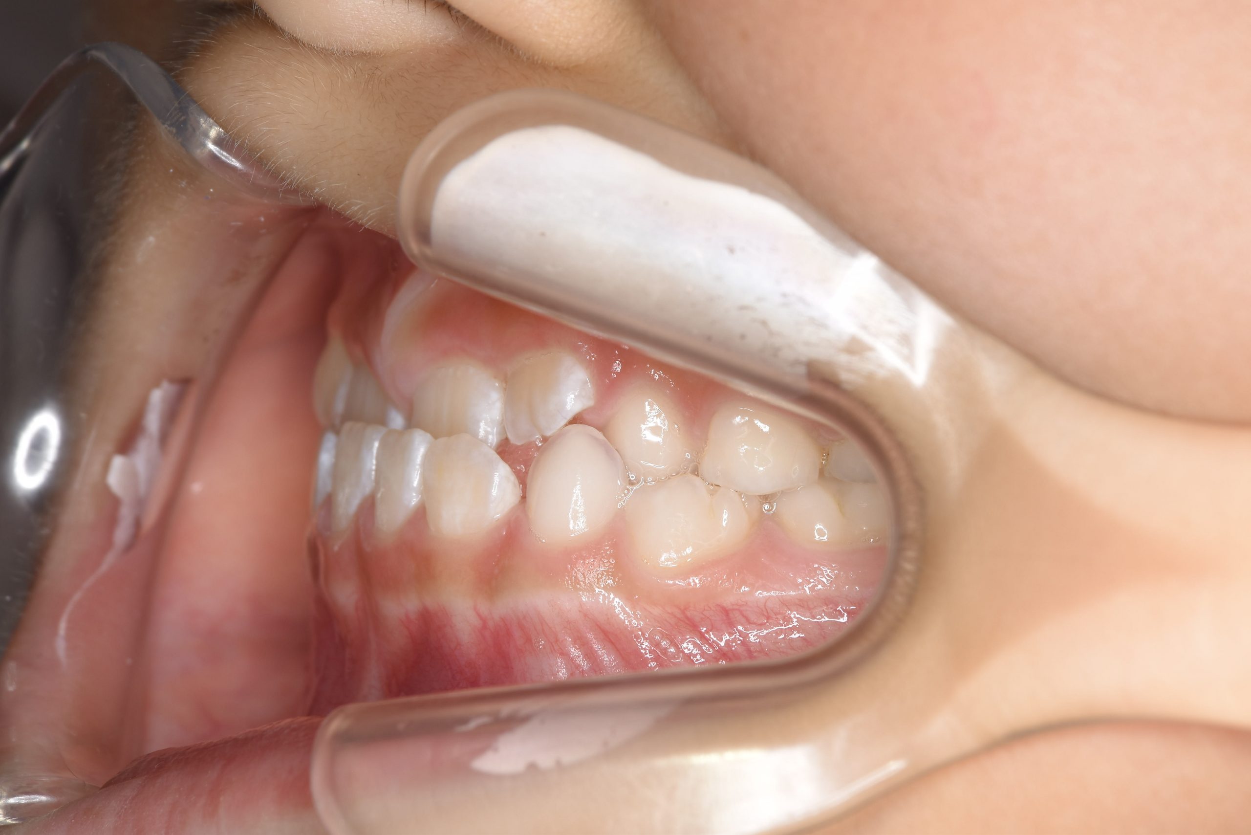 全顎ワイヤー矯正　症例_858