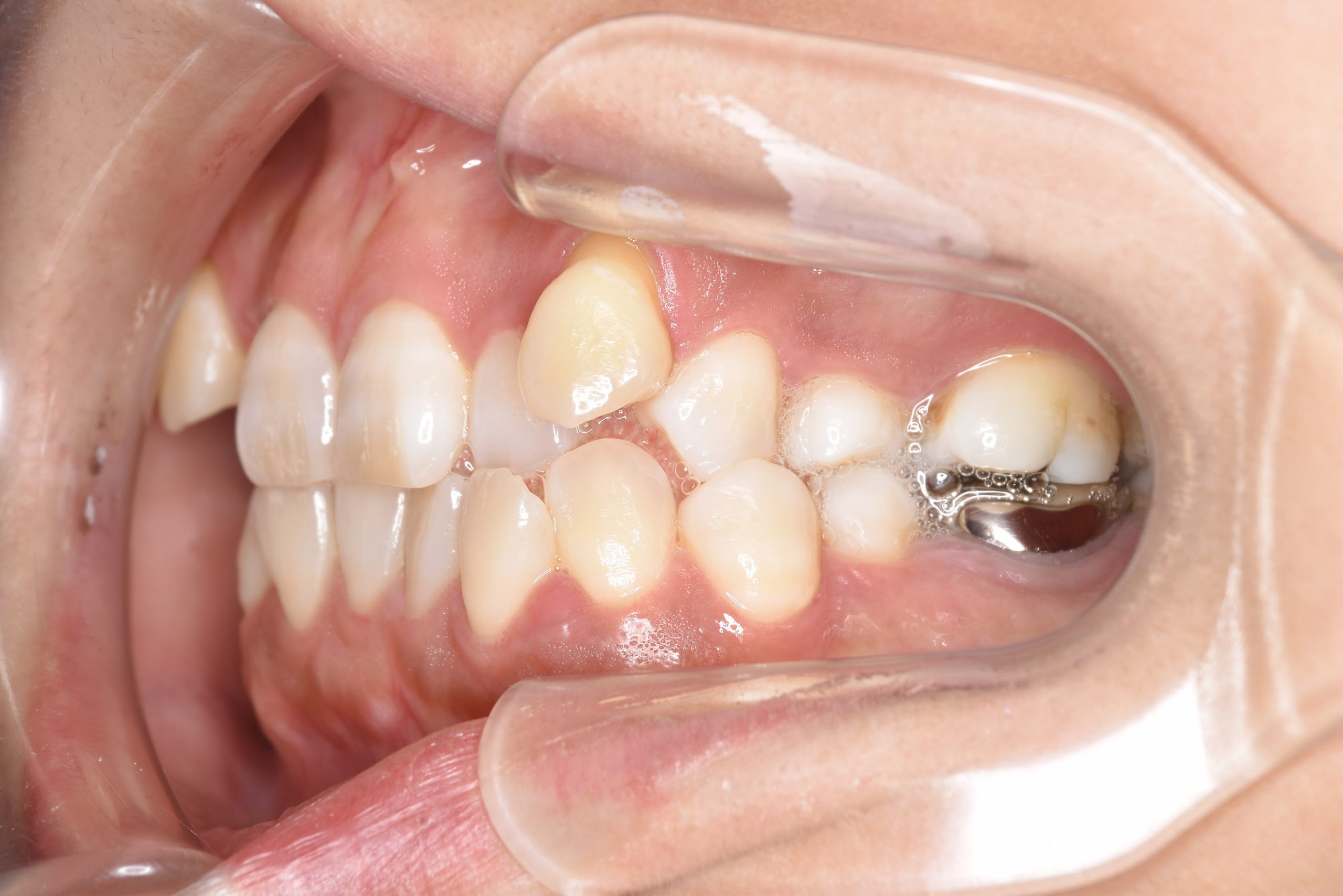 全顎ワイヤー矯正　症例_141