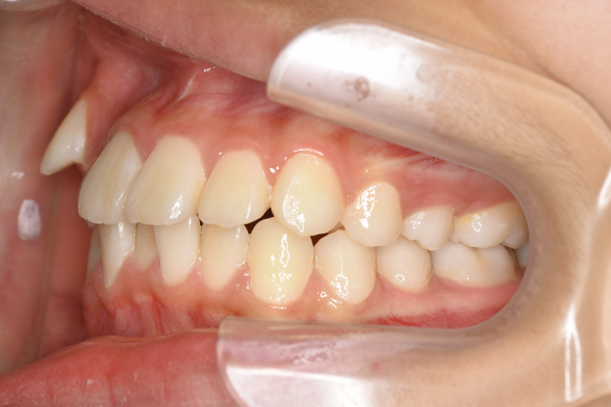 全顎ワイヤー矯正　症例_1324