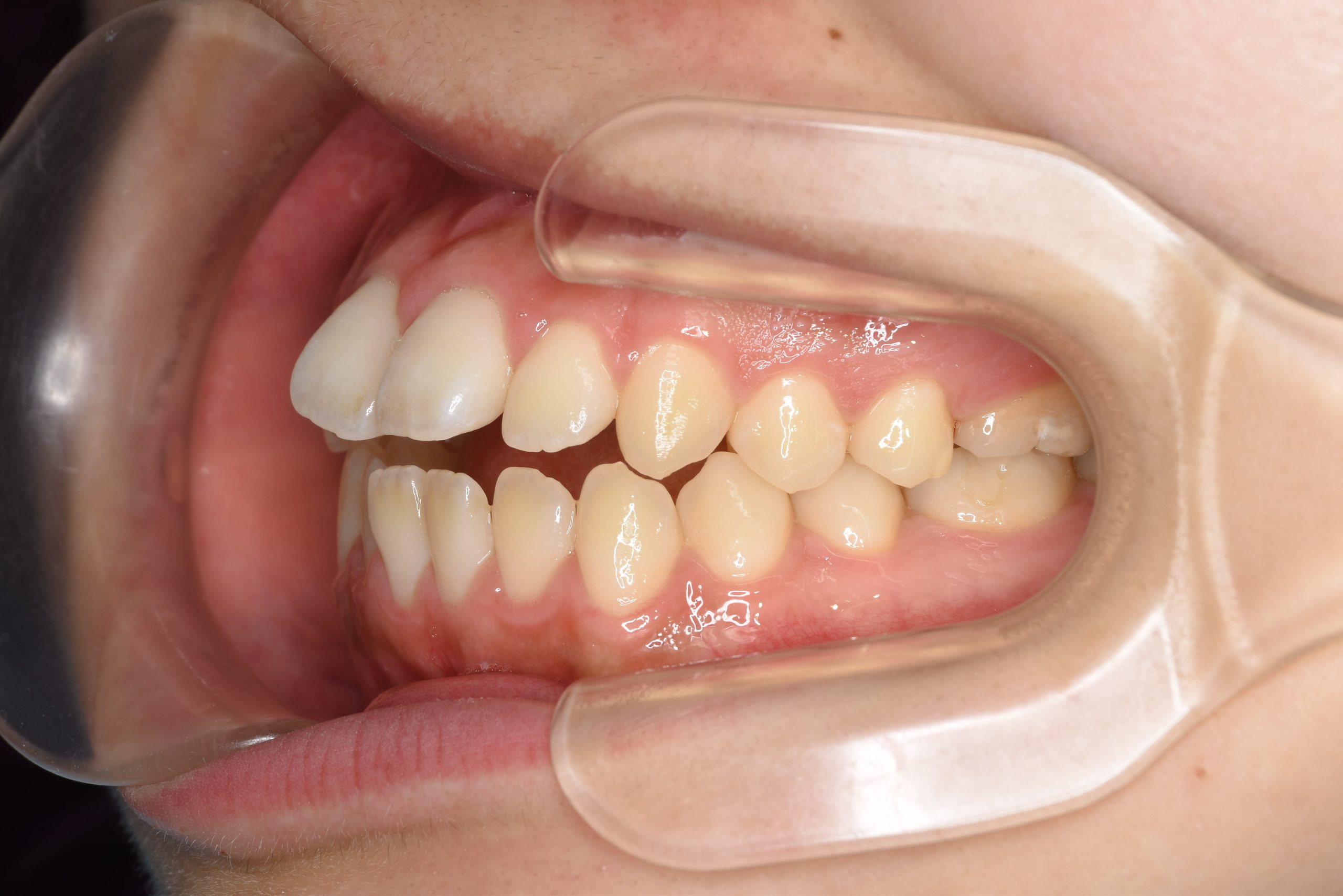 全顎ワイヤー矯正　症例_1409