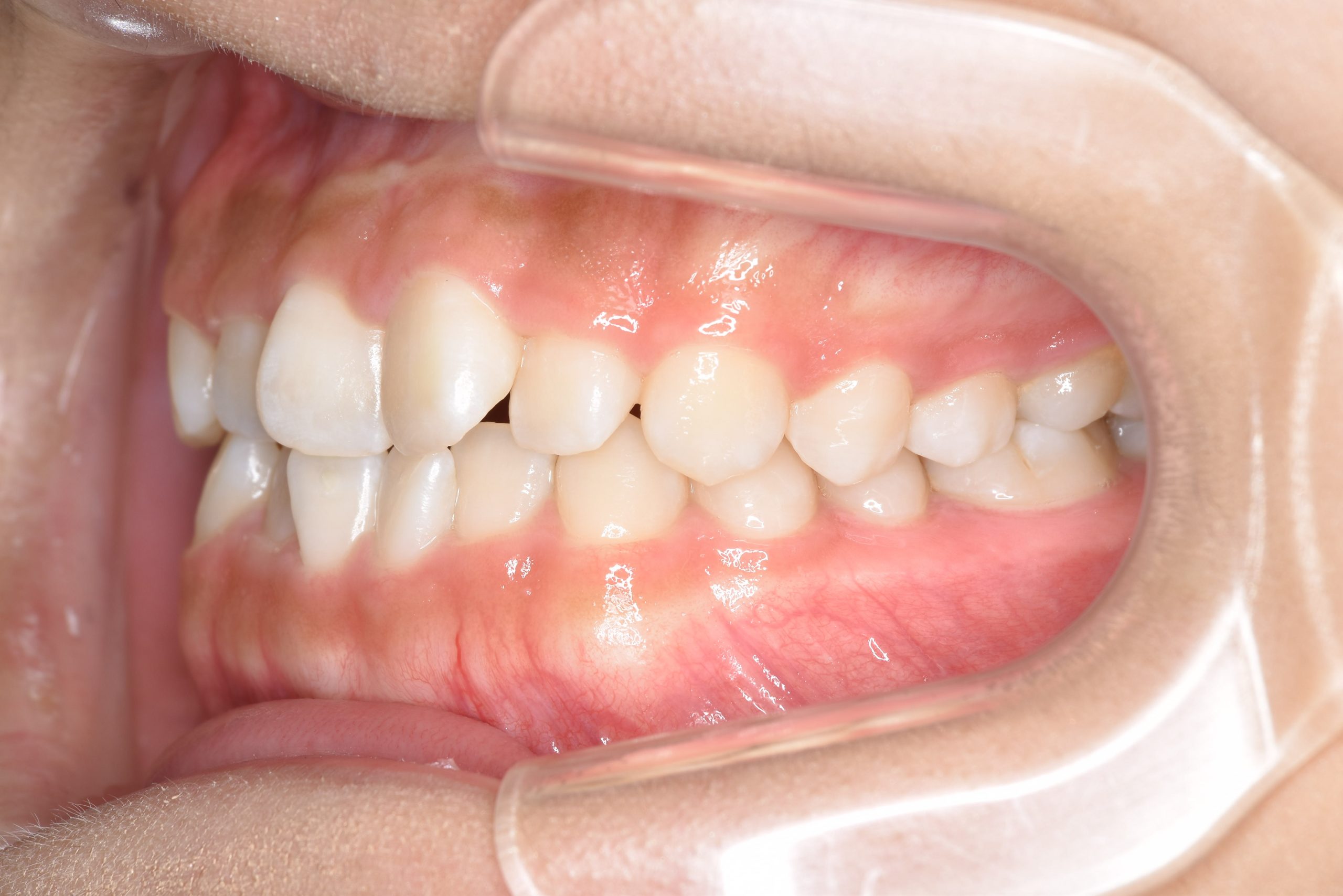 全顎ワイヤー矯正　症例_148