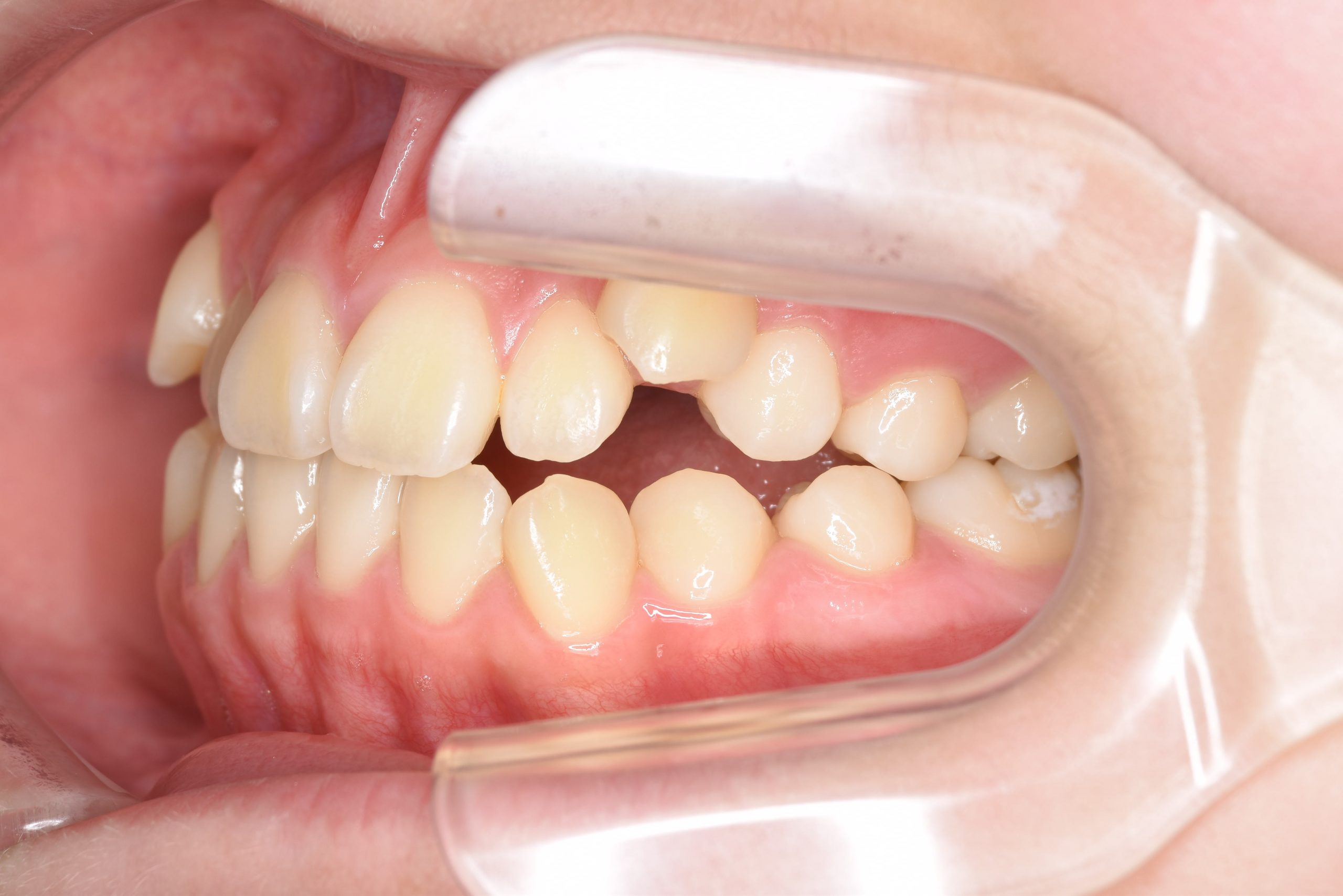 全顎ワイヤー矯正　症例_154