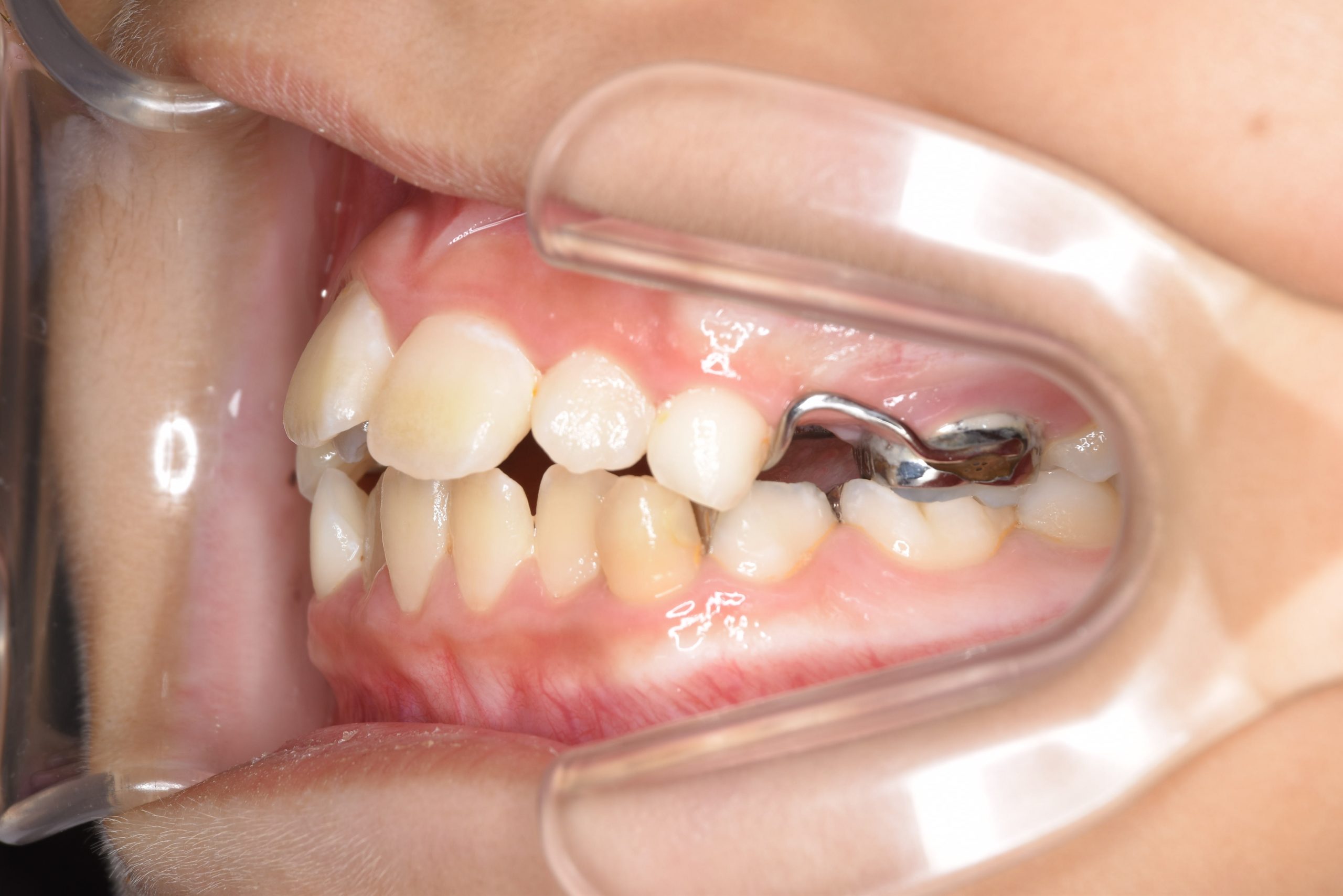 全顎ワイヤー矯正　症例_169