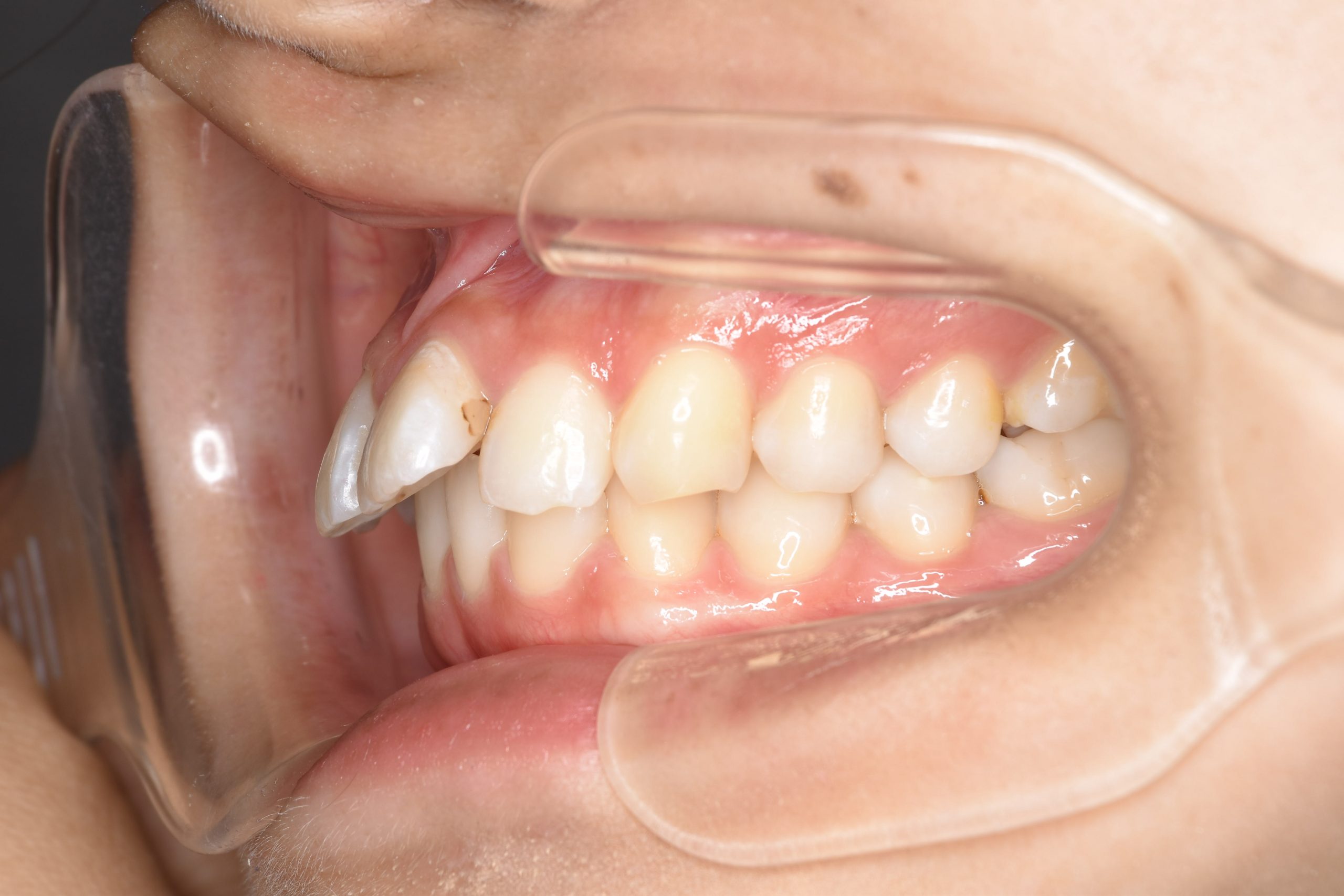 全顎ワイヤー矯正　症例_182