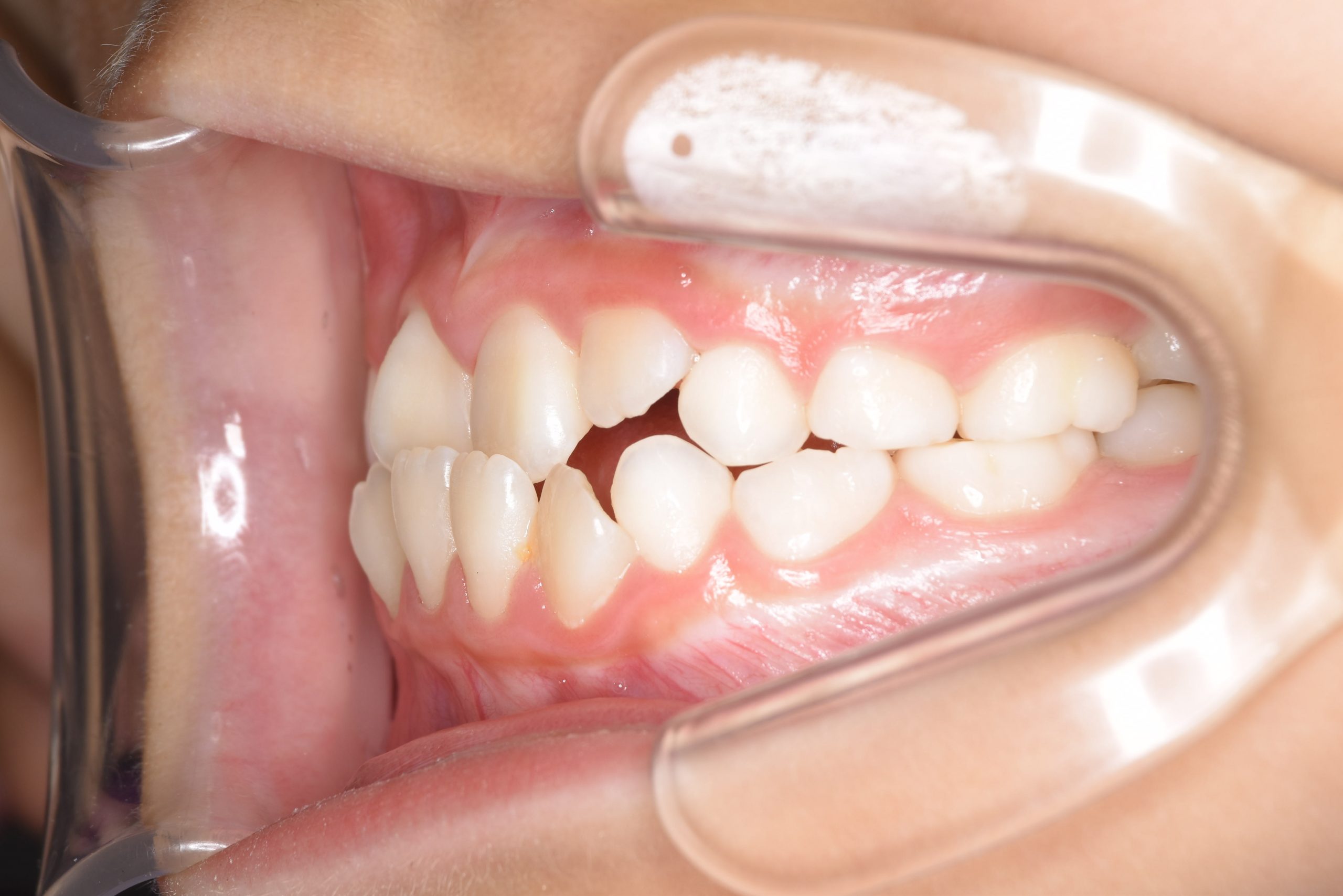 全顎ワイヤー矯正　症例_68