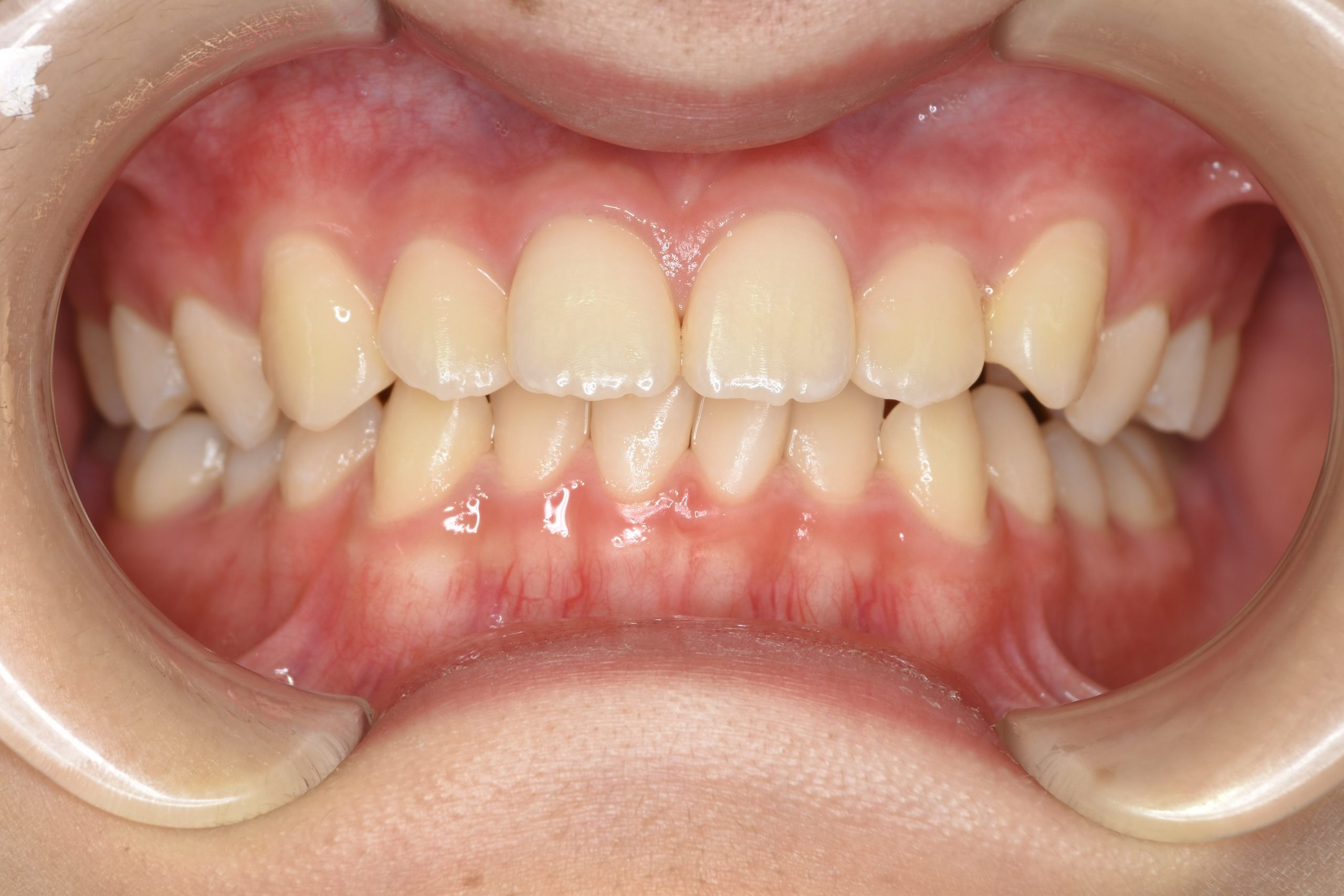 全顎ワイヤー矯正　症例_185