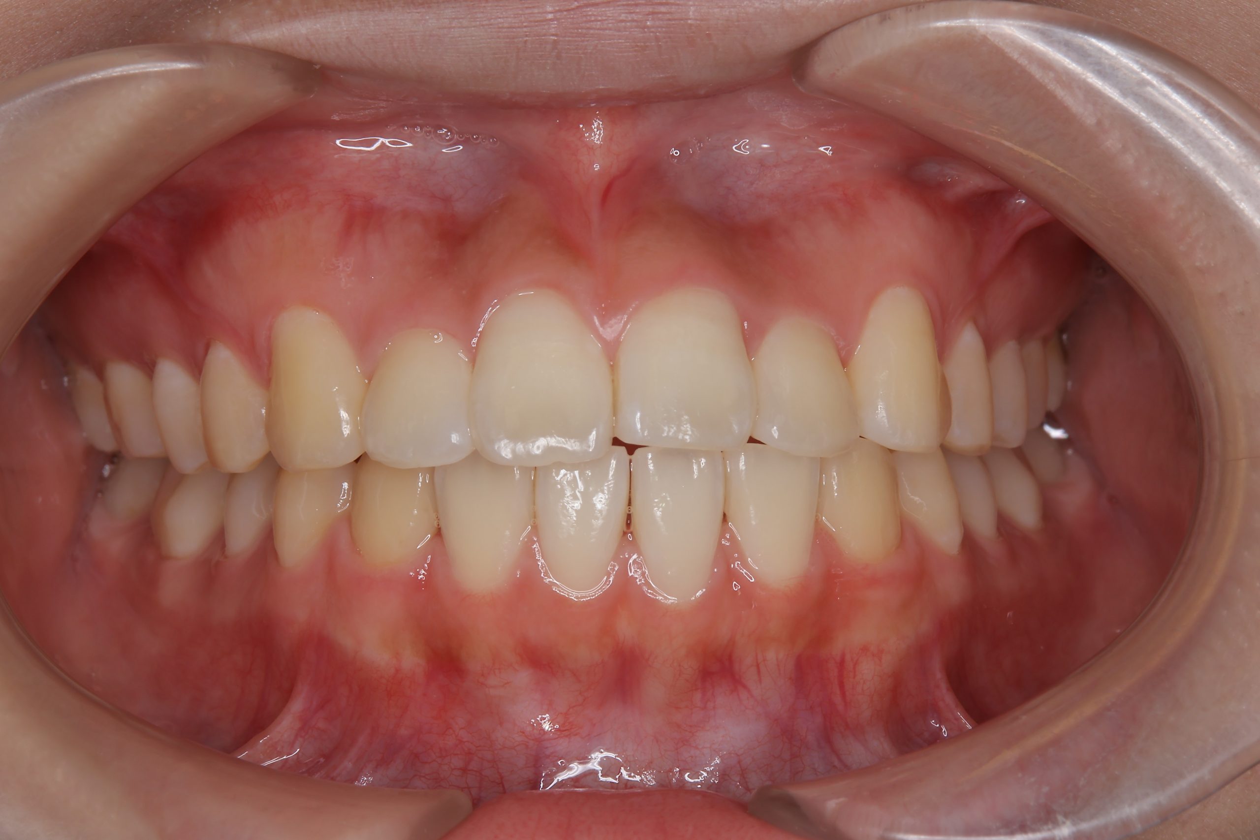 全顎ワイヤー矯正　症例_191