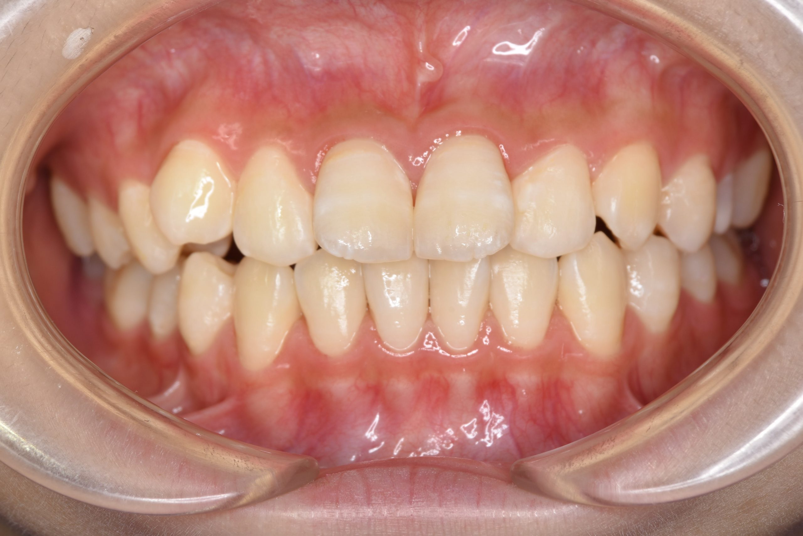 全顎ワイヤー矯正　症例_198