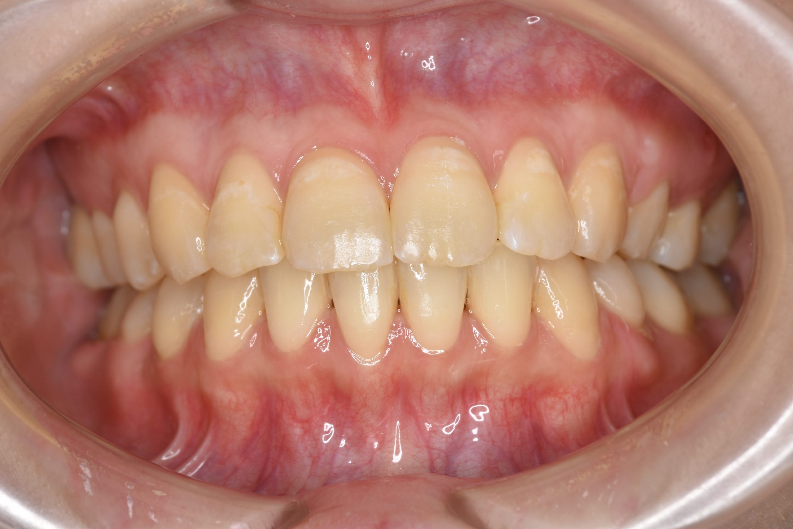 全顎ワイヤー矯正　症例_200