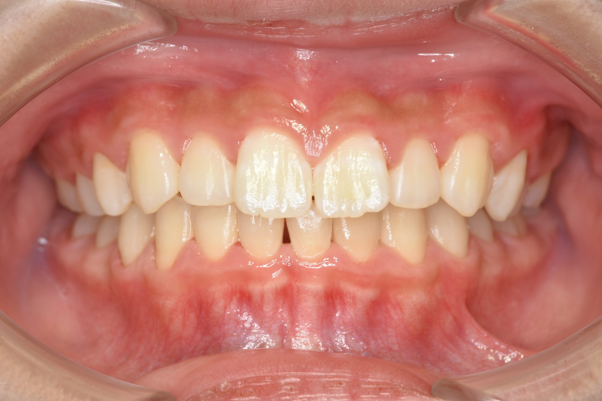 全顎ワイヤー矯正　症例_218